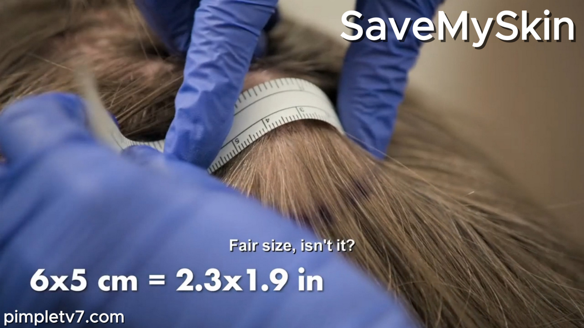 Howell has a large and uncomfortable lump on his head. SaveMySkin 240826