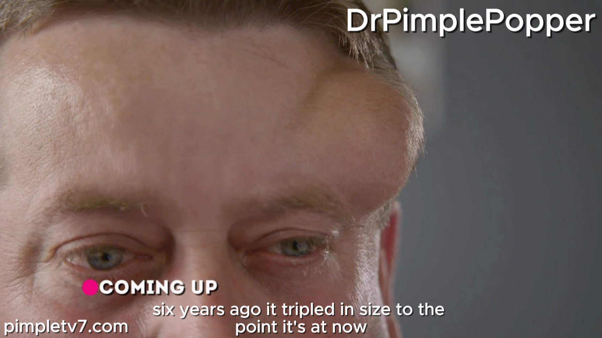 James has a large, squishy lump on his forehead. Dr. Pimple Popper 310726