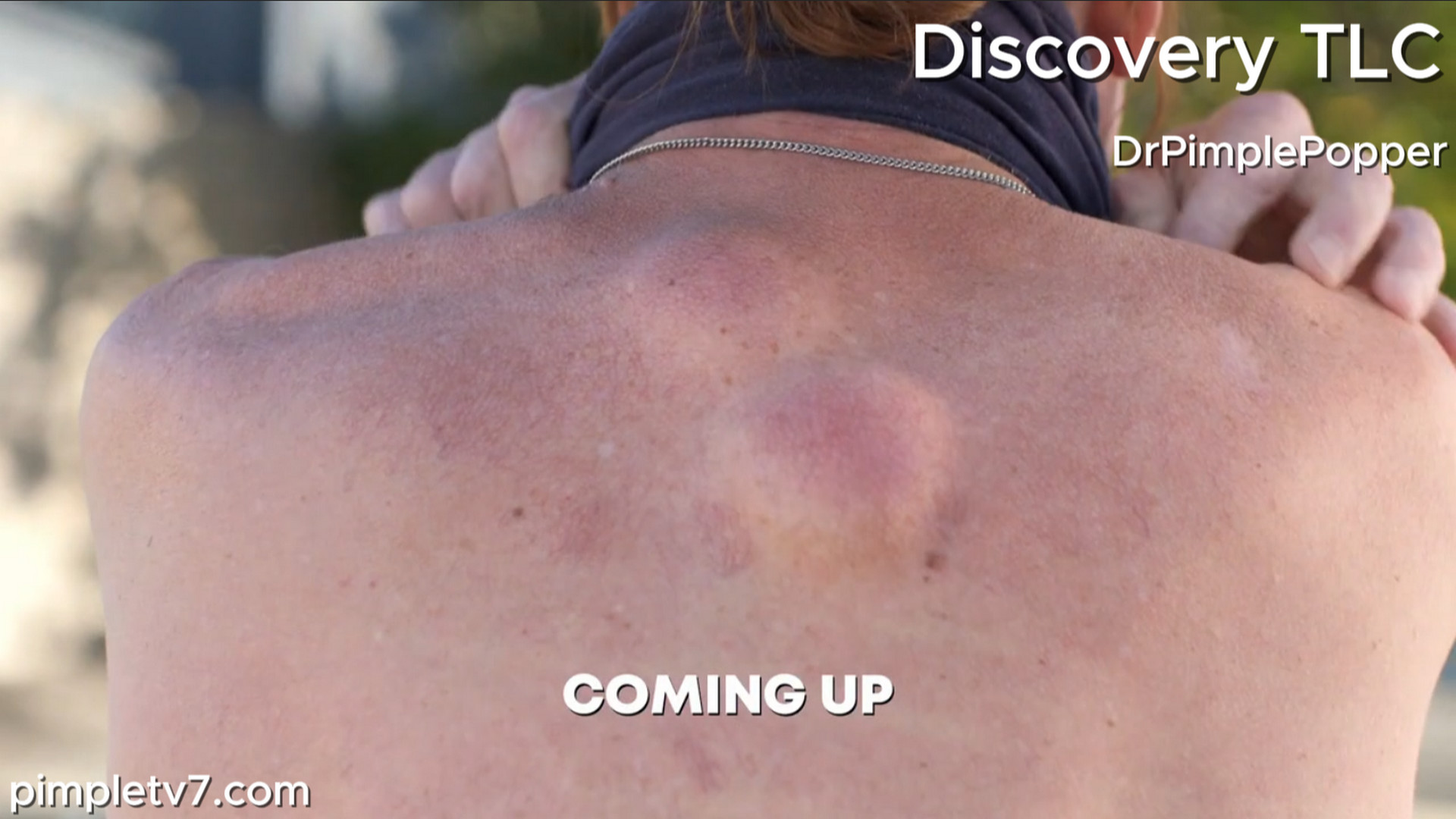 James has demons on his back that are ruining his life! Dr. Pimple Popper 010826
