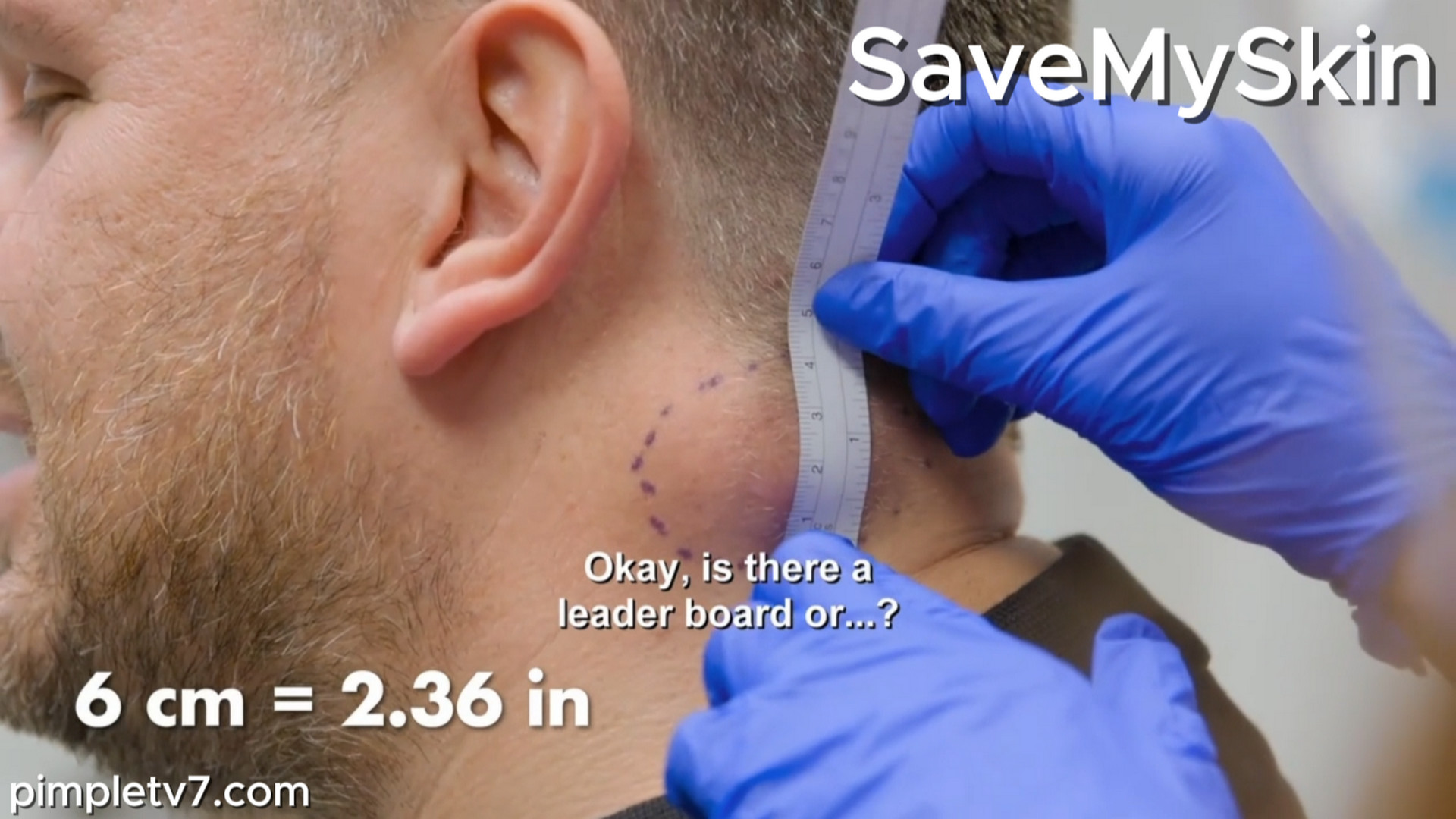 James’ unsightly cyst affects his job. Discovery TLC SaveMySkin 220826