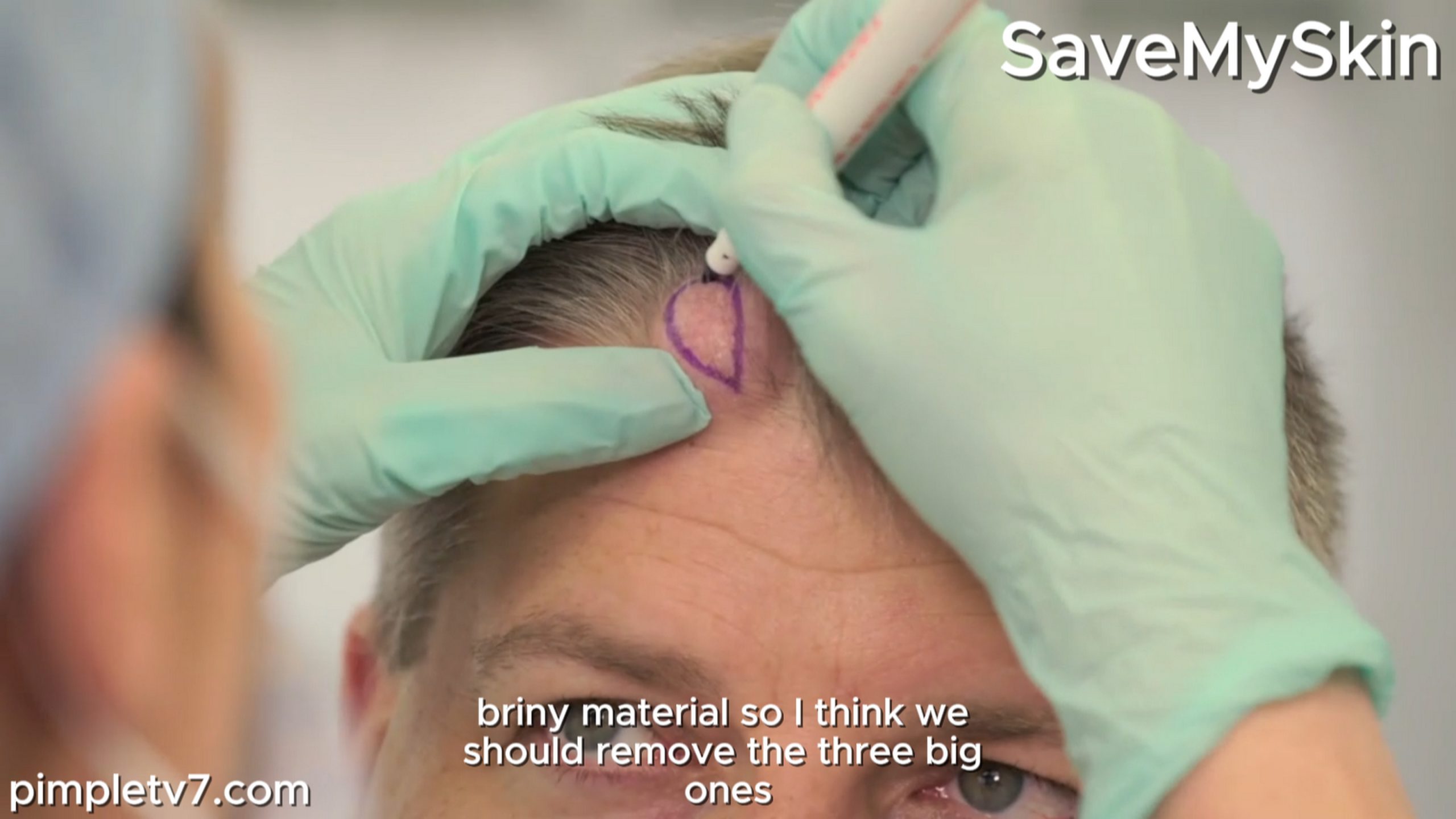 James would like the lumps on his head removed. SaveMySkin 210826