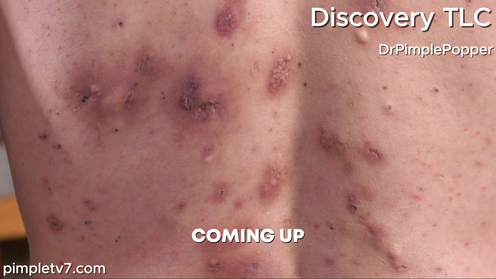 Jeb loves the beach but refuses to go because of the massive number of blackheads, pimples, and cysts all over his body. Dr. Pimple Popper 100826