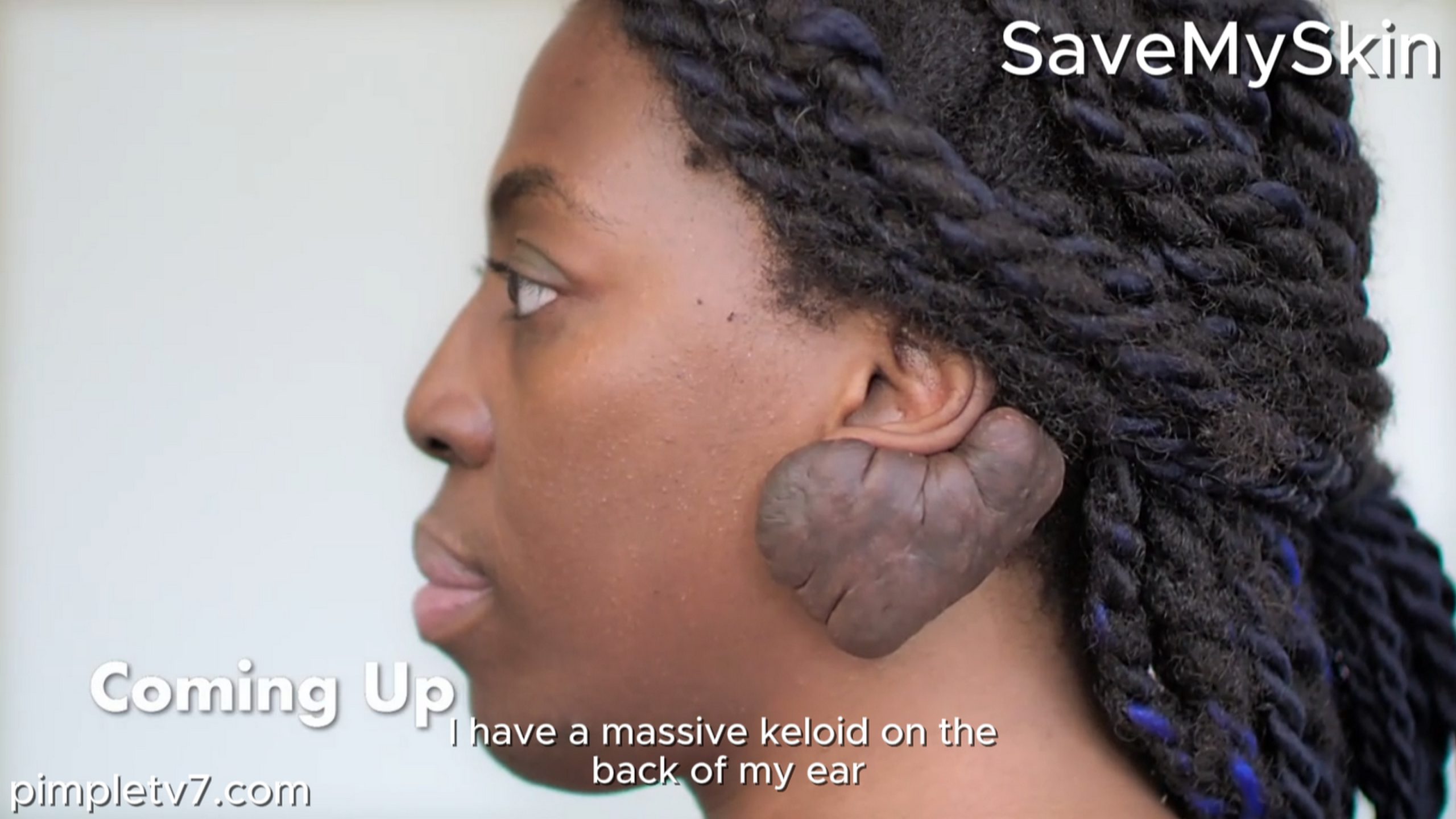 Jenny’s massive keloid is affecting her hearing. SaveMySkin 190826