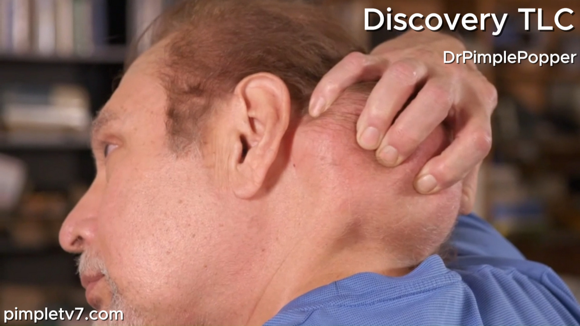 Jess is a widower looking for love who is stuck with a giant bump on his neck. Dr. Pimple Popper 080826