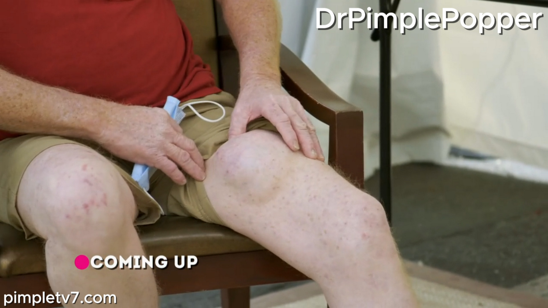 Jim is a widower with two lumps who wants them removed for himself and his late wife. Dr. Pimple Popper 110826