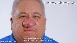 Jorge’s case of rhinophyma is so bad that he has a difficult time breathing. MercyMercyMe 210826