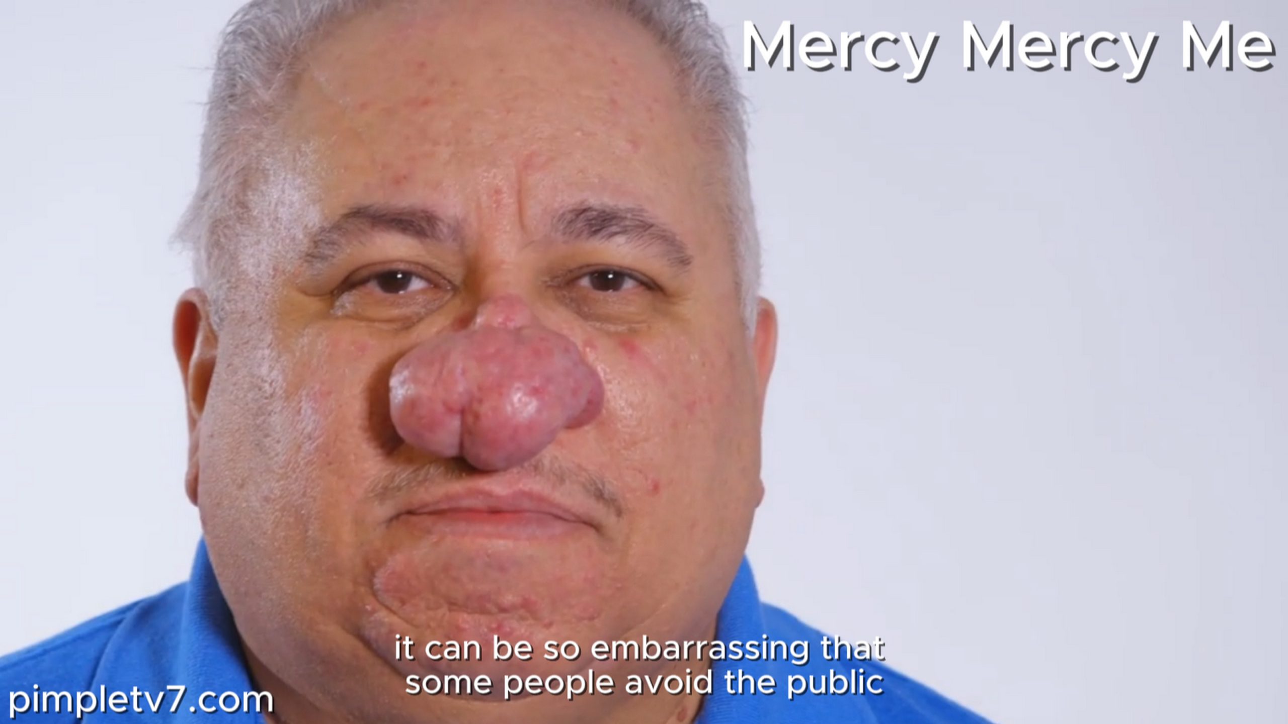 Jorge’s case of rhinophyma is so bad that he has a difficult time breathing. MercyMercyMe 210826