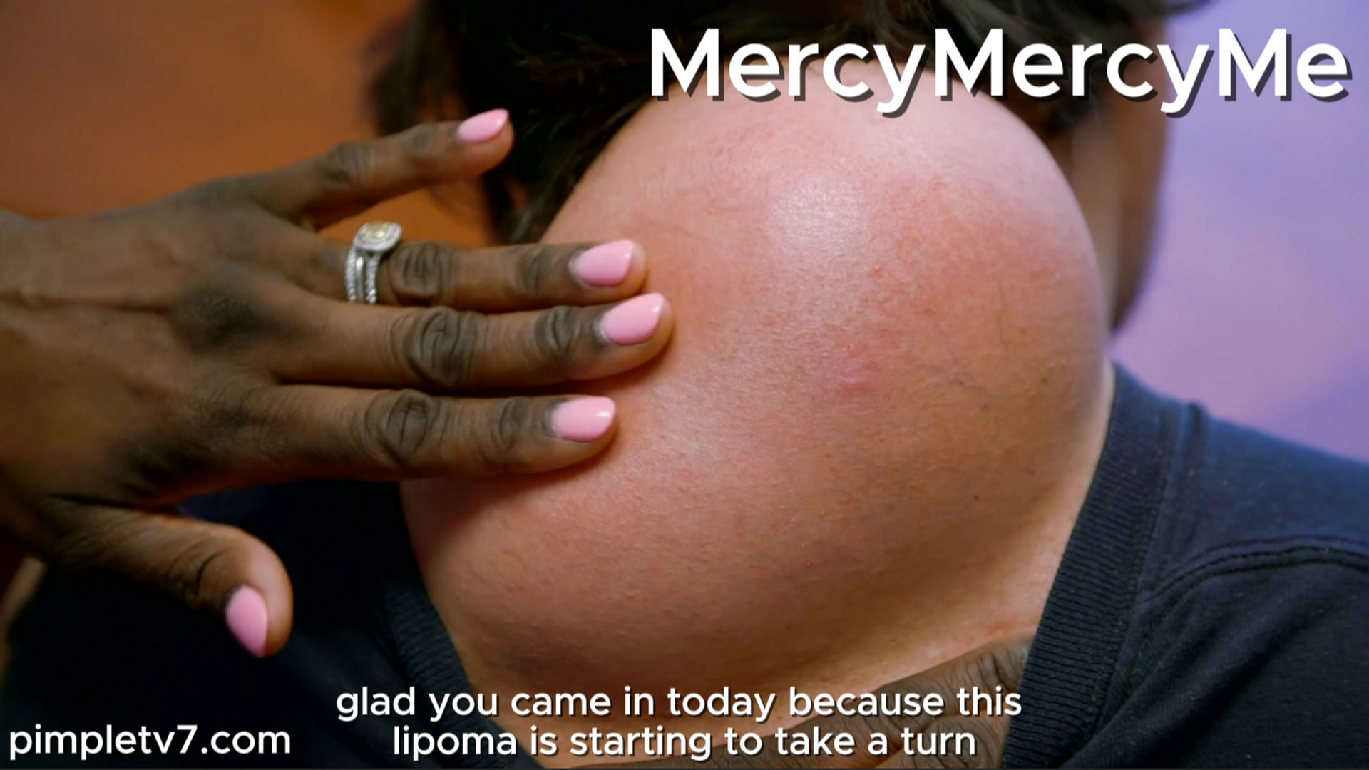 Joseph’s neck lipoma gets in the way of everything he does. MercyMercyMe 190826