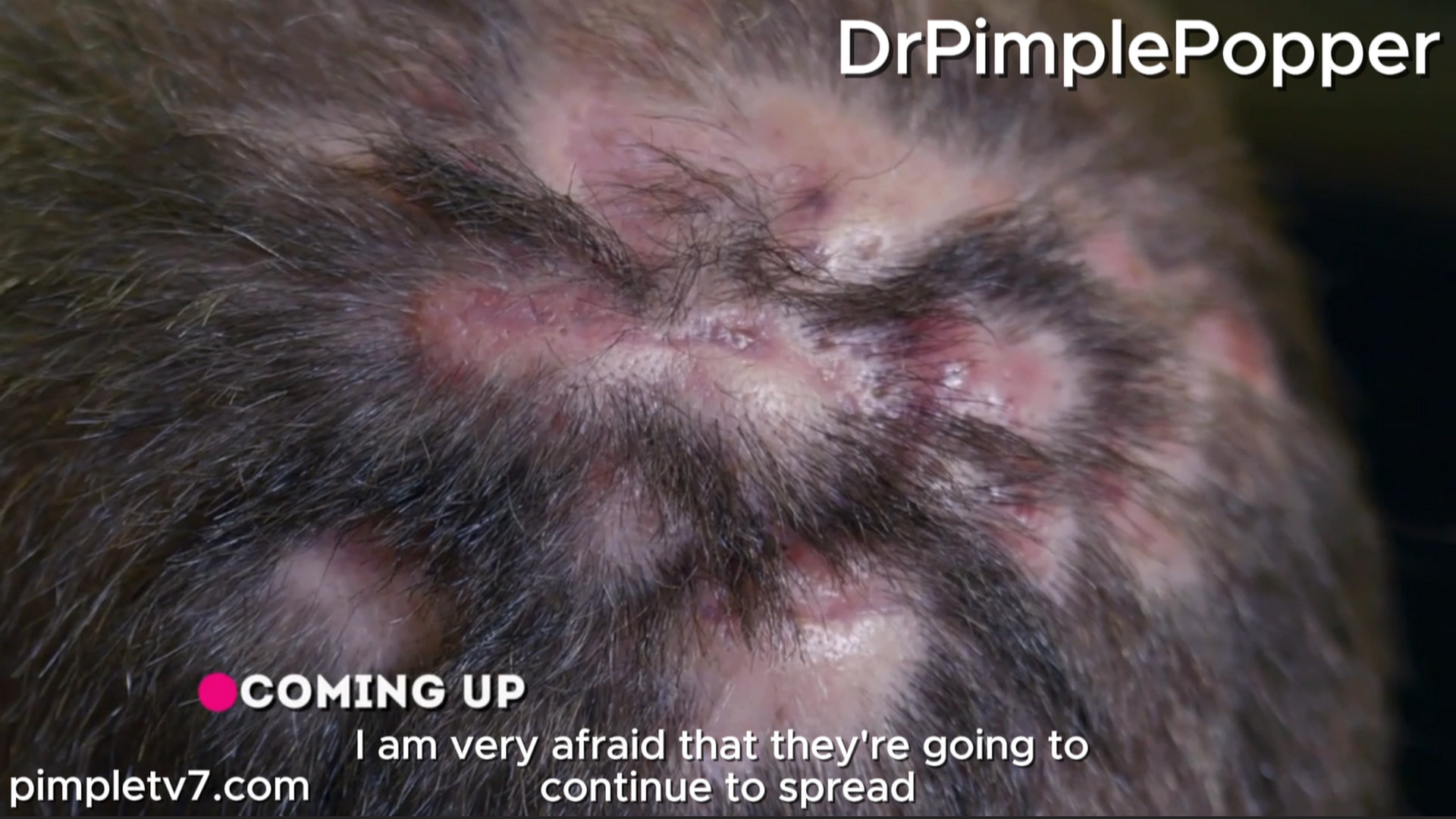 Justin has painful mystery bumps all over his head. Dr. Pimple Popper 020826