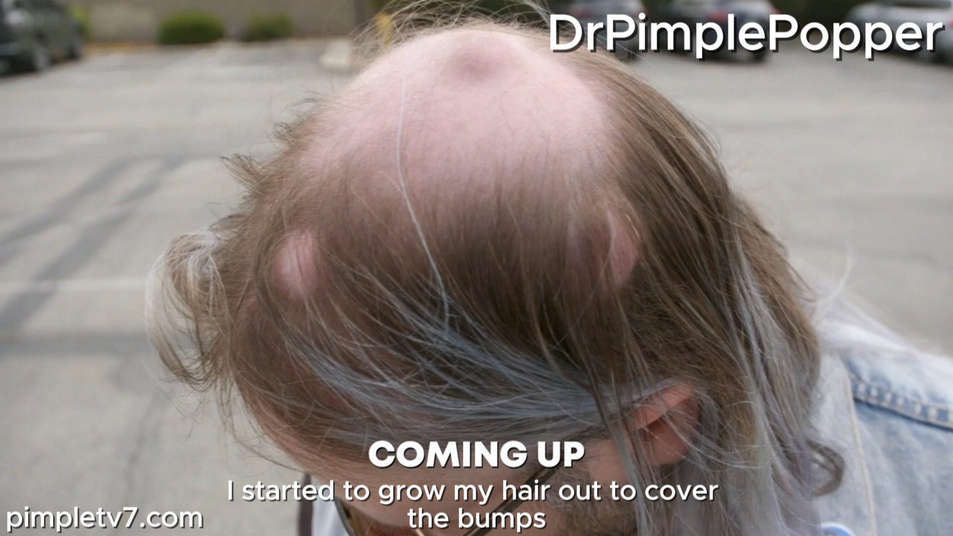 Justin is a dude rockin’ a “man bun,” but he’s having no fun due to the bumps poking his scalp. Dr. Pimple Popper 130826