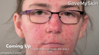 Katie’s rosacea has gotten worse since her pregnancy. SaveMySkin 160826
