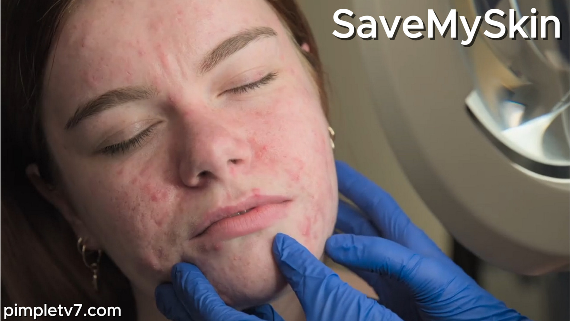 Kayleigh’s severe acne cripples her confidence. SaveMySkin 240826