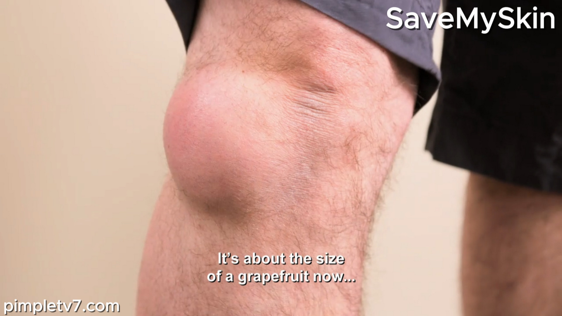 Keith’s lipoma is affecting his mobility. SaveMySkin 010826
