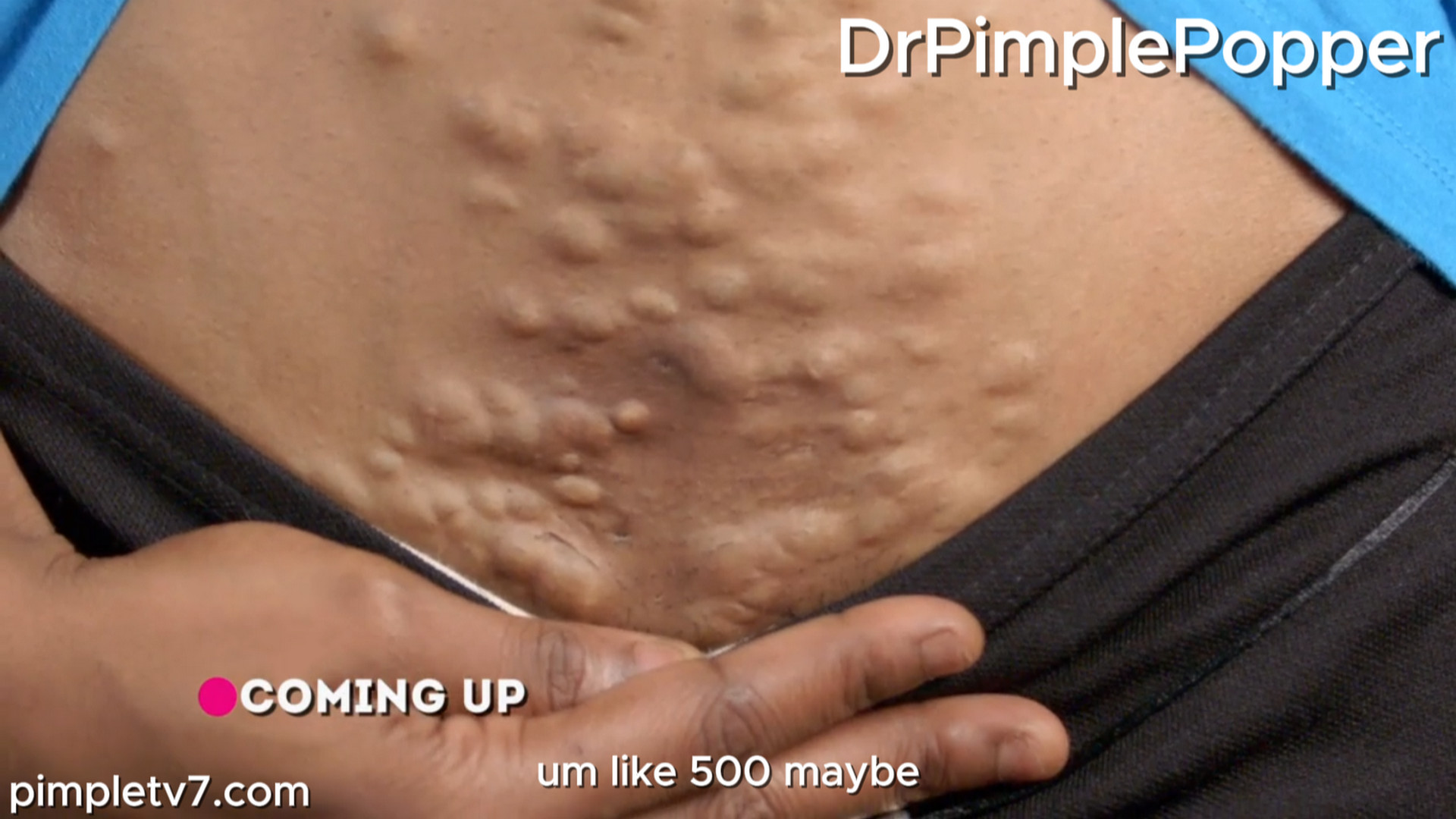 Keke is covered in bumps that make her embarrassed to be intimate with her husband. Dr. Pimple Popper 110826