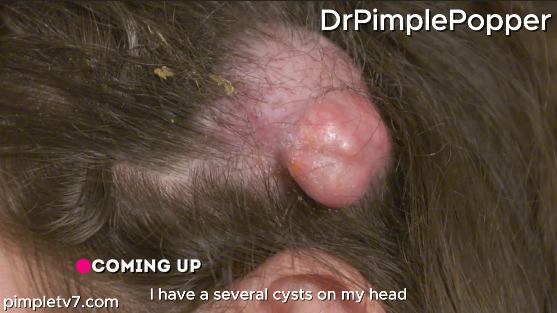 Ken has several large cysts on his head that he has tried to remove on his own. Dr. Pimple Popper 090826