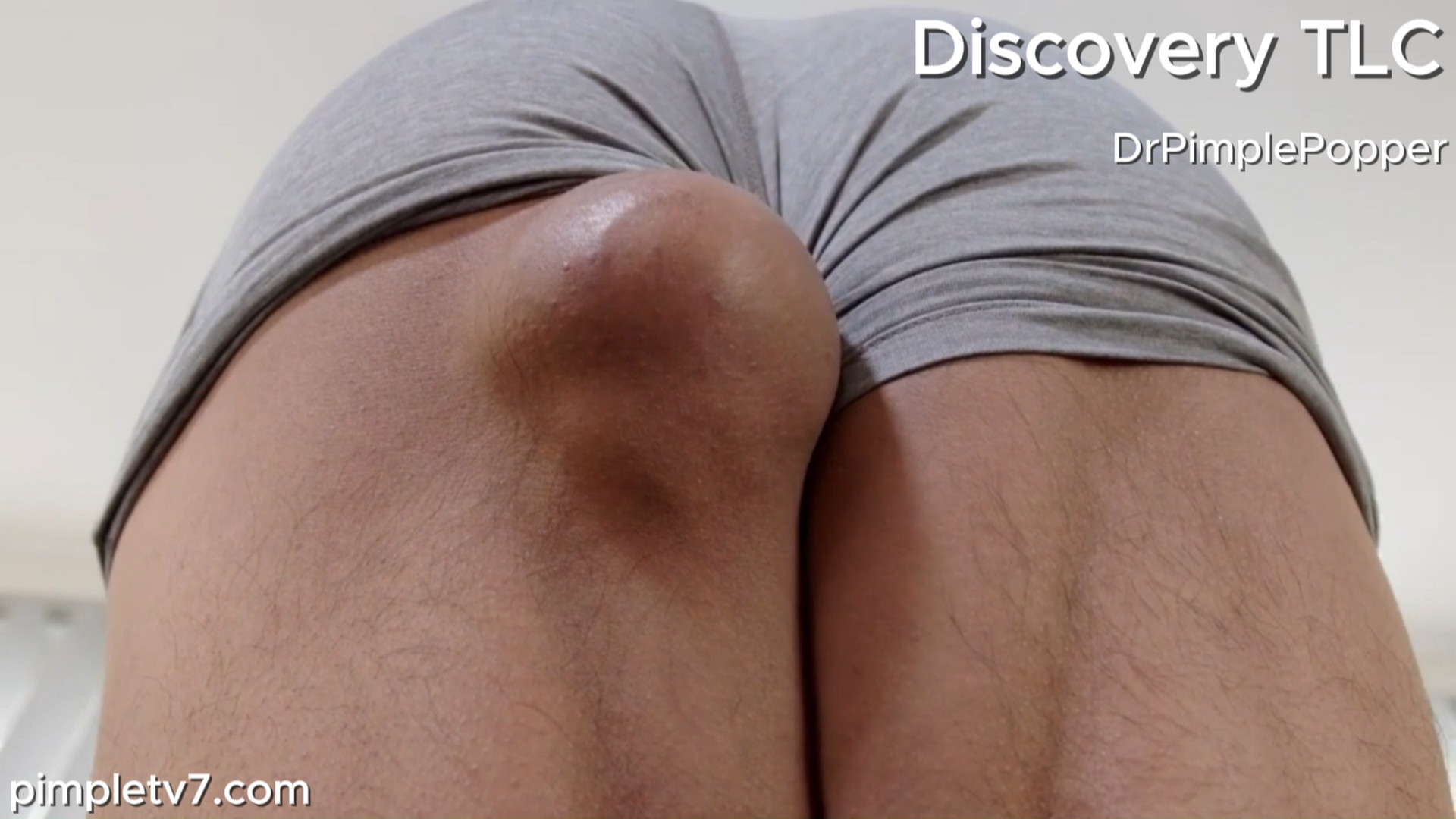 Keven wants to get a butt lipoma removed to get his tush back into a regular shape. Dr. Pimple Popper 020826