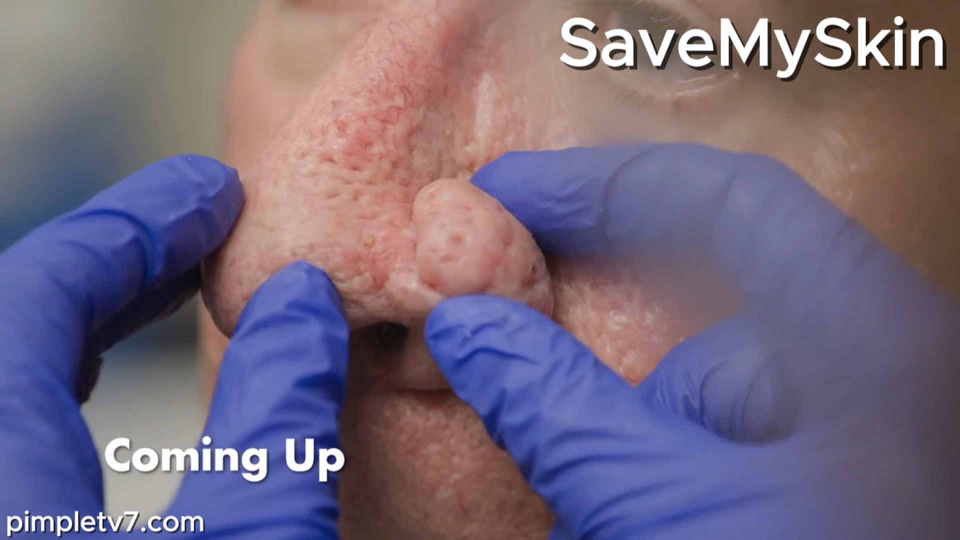 Kevin’s lump on his nose has destroyed his confidence. SaveMySkin 190826