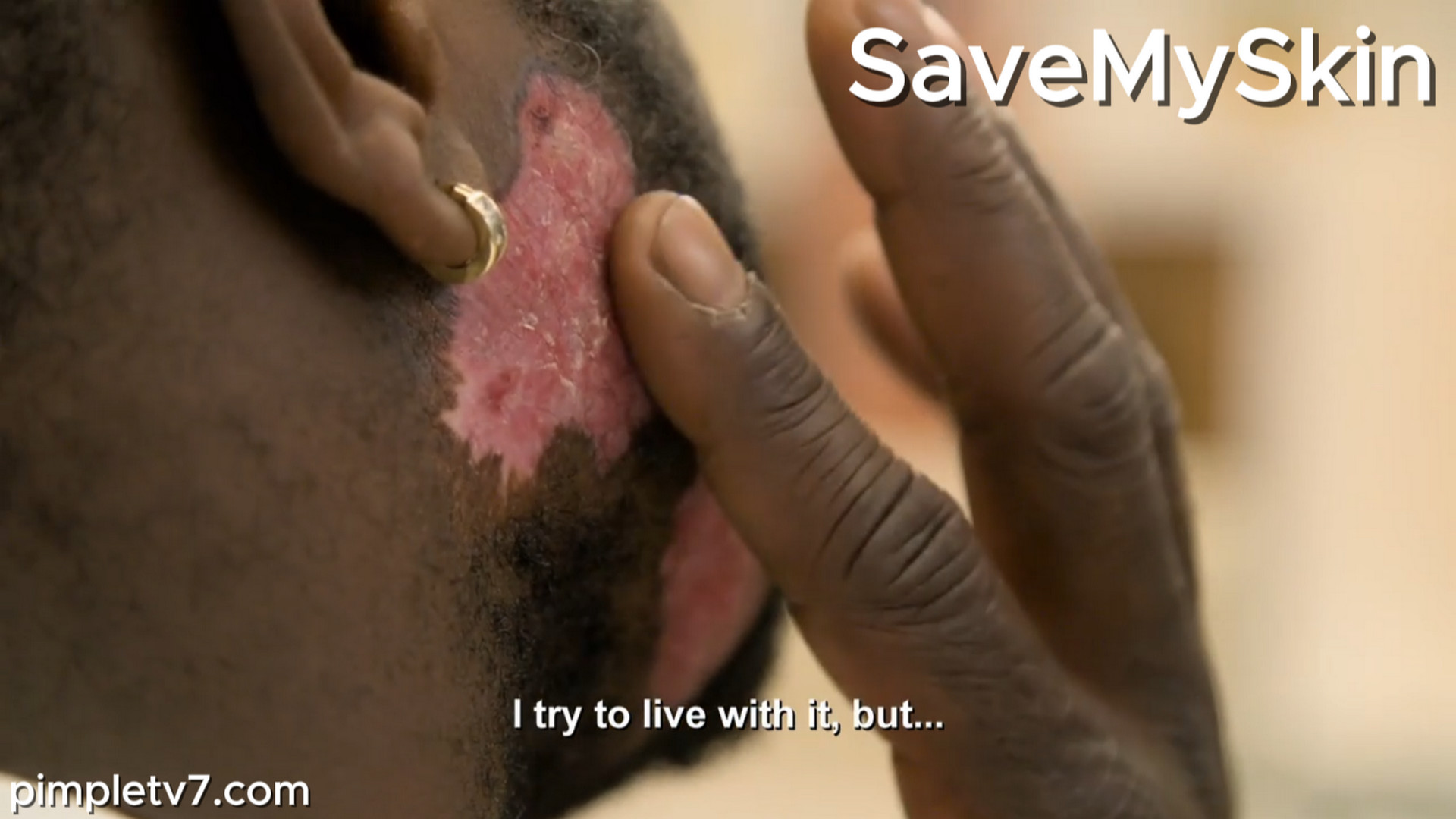 Kzartan prays Dr. Emma can diagnose the unsightly patches growing on his face. SaveMySkin 200826
