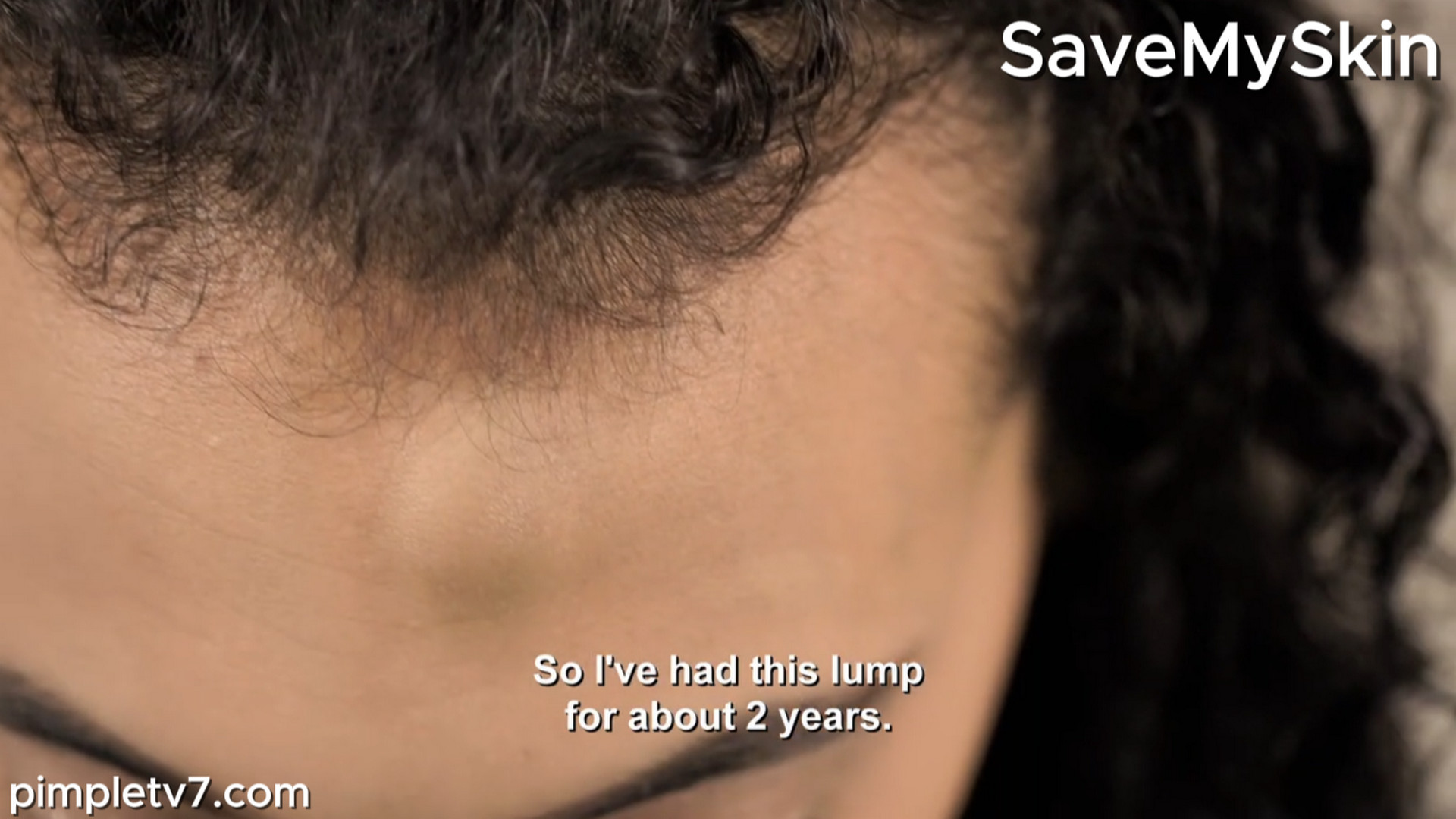 Lauren consults Dr. Emma about an unsightly forehead lump. SaveMySkin 170826