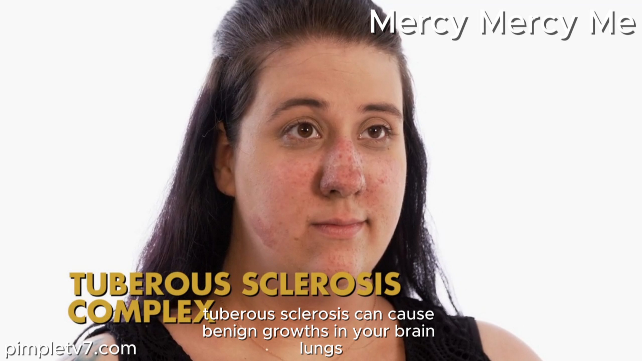 Lauren has a condition that gives her bumps inside and outside of her body. MercyMercyMe 230826
