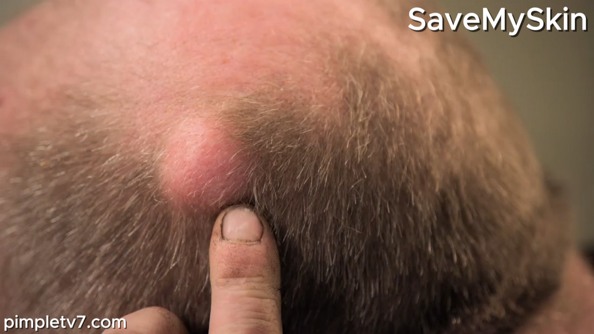 Lee is desperate to have a cyst removed. SaveMySkin 130826