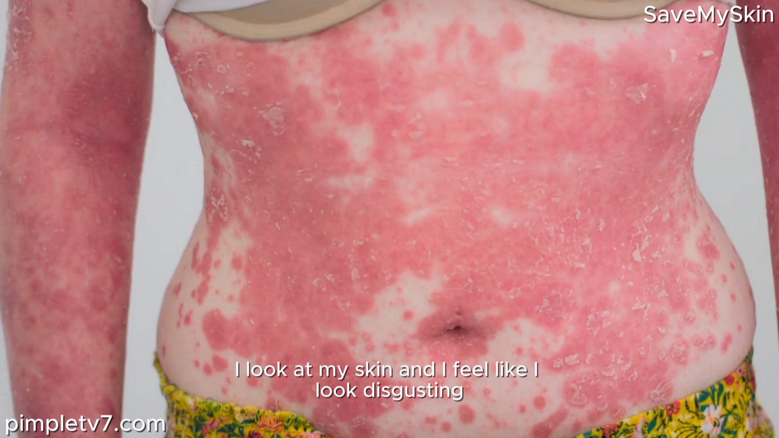 Lucy’s painful skin condition is preventing her from being the mom she wants to be. SaveMySkin 070826