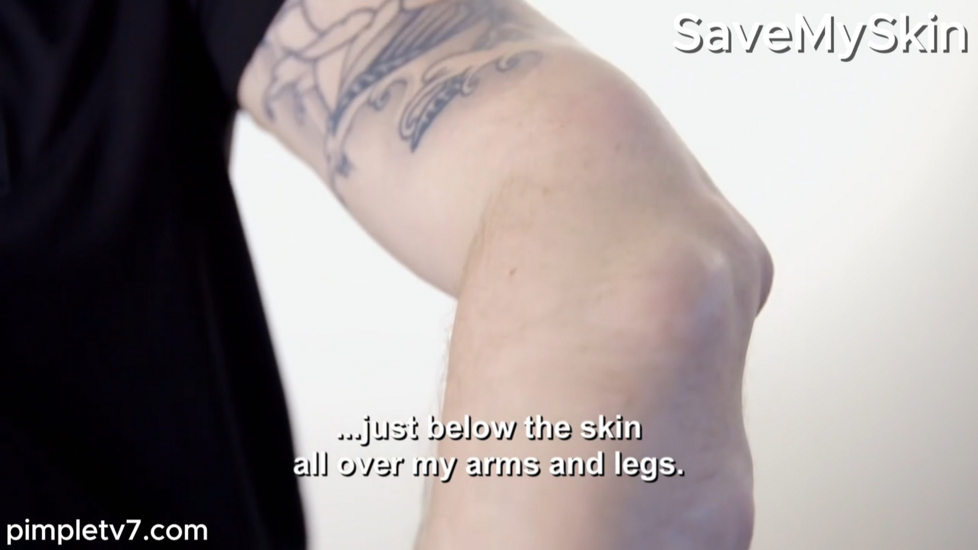 Lumps have taken over Jonathan’s body. SaveMySkin 030826