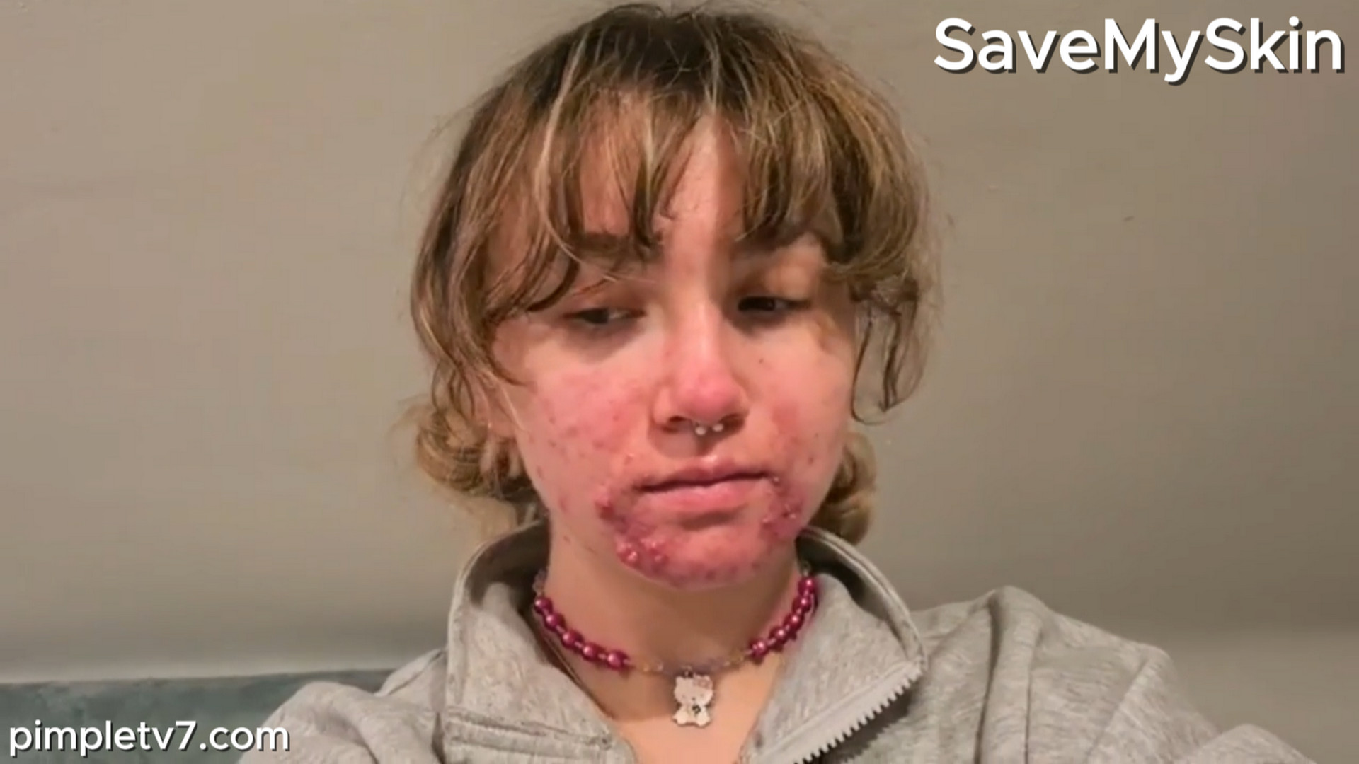 Lydia is tired of being known as “the acne gal.” Dr. Pimple Popper 160826