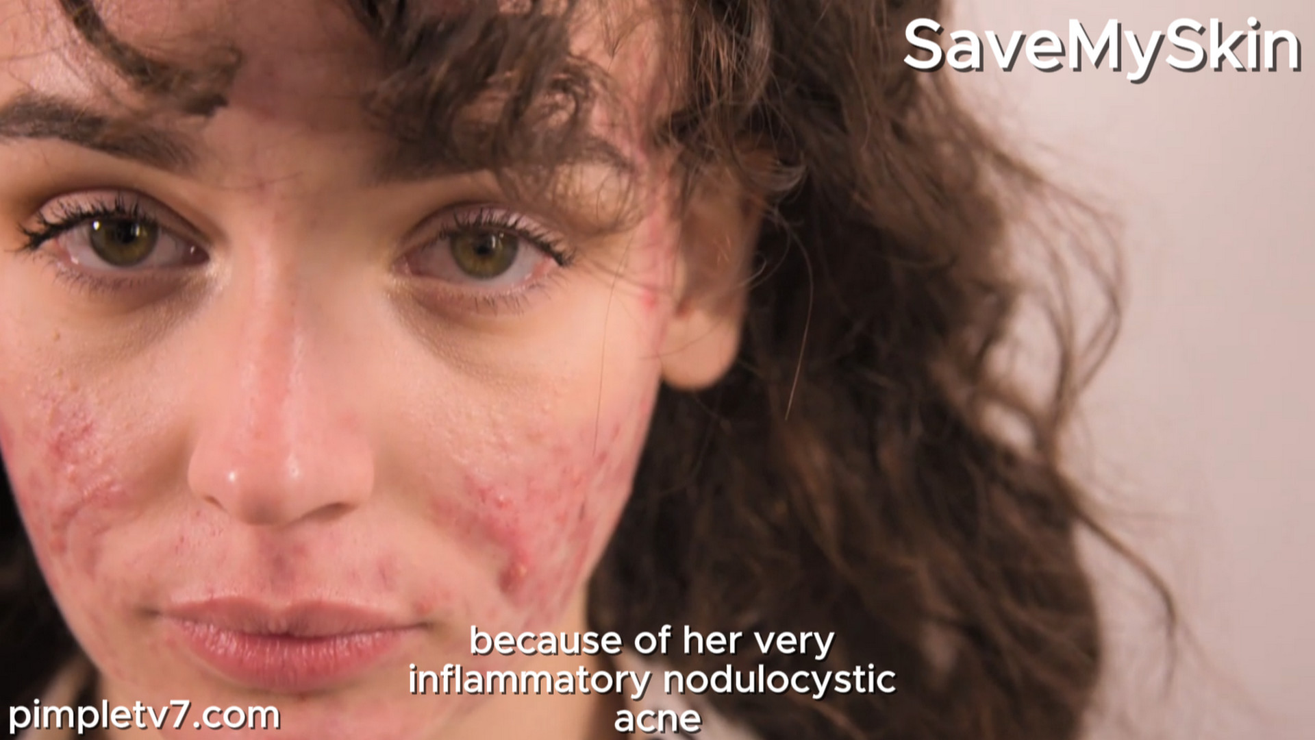 Mariah is back in Dr. Emma’s office to treat scarring from her acne. SaveMySkin 230826