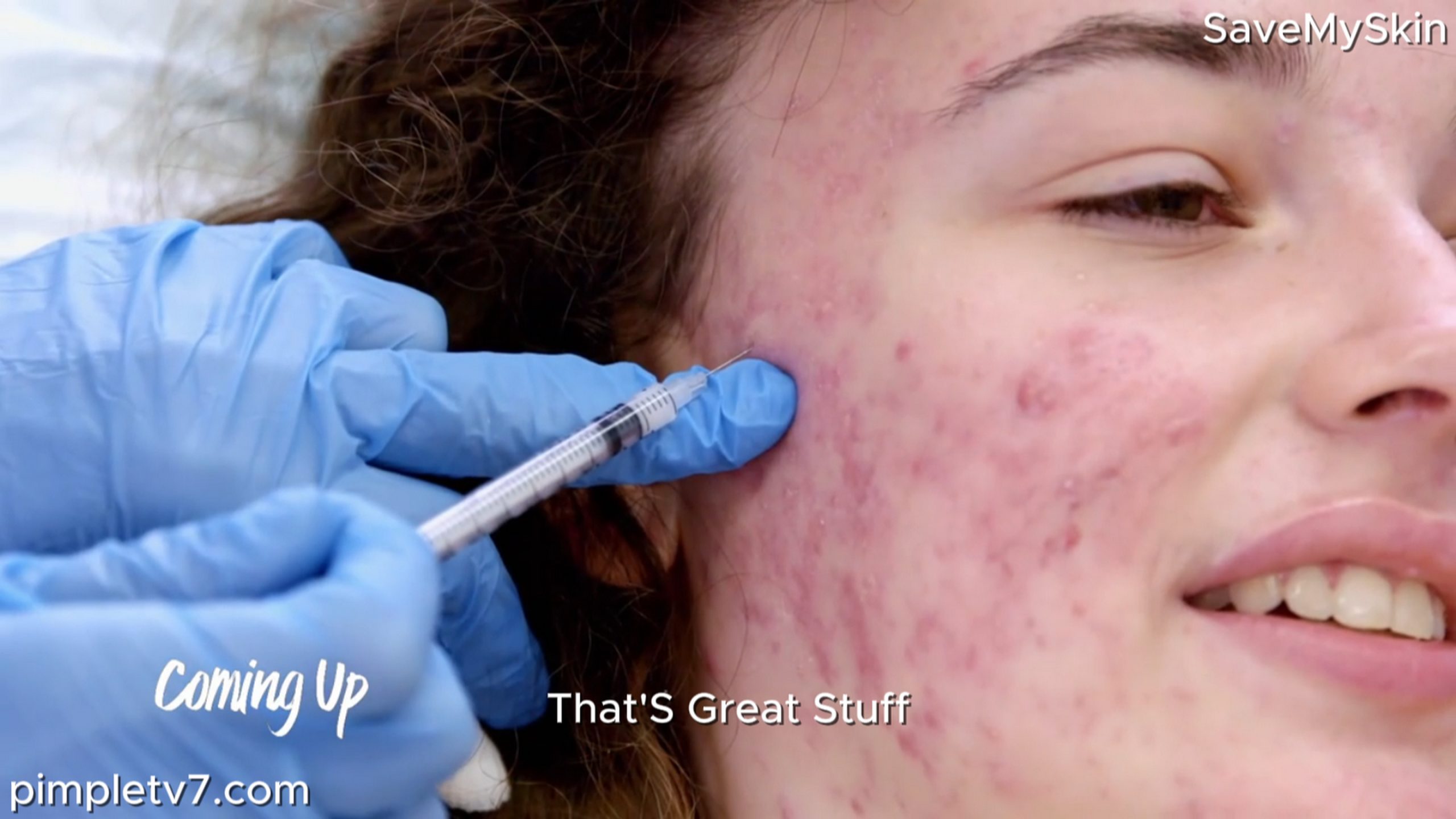 Mariah’s acne has completely destroyed her self-confidence. SaveMySkin 040826