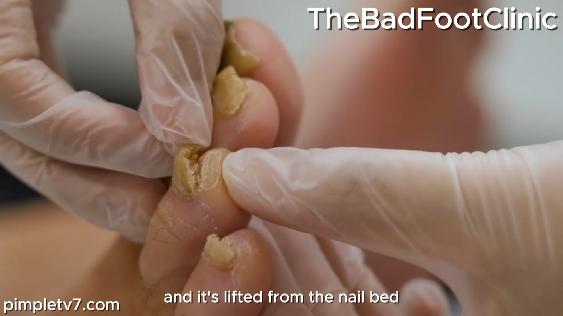 Mark has one of the most severe cases of fungal nails that Marion has seen. TheBadFootClinic 170826