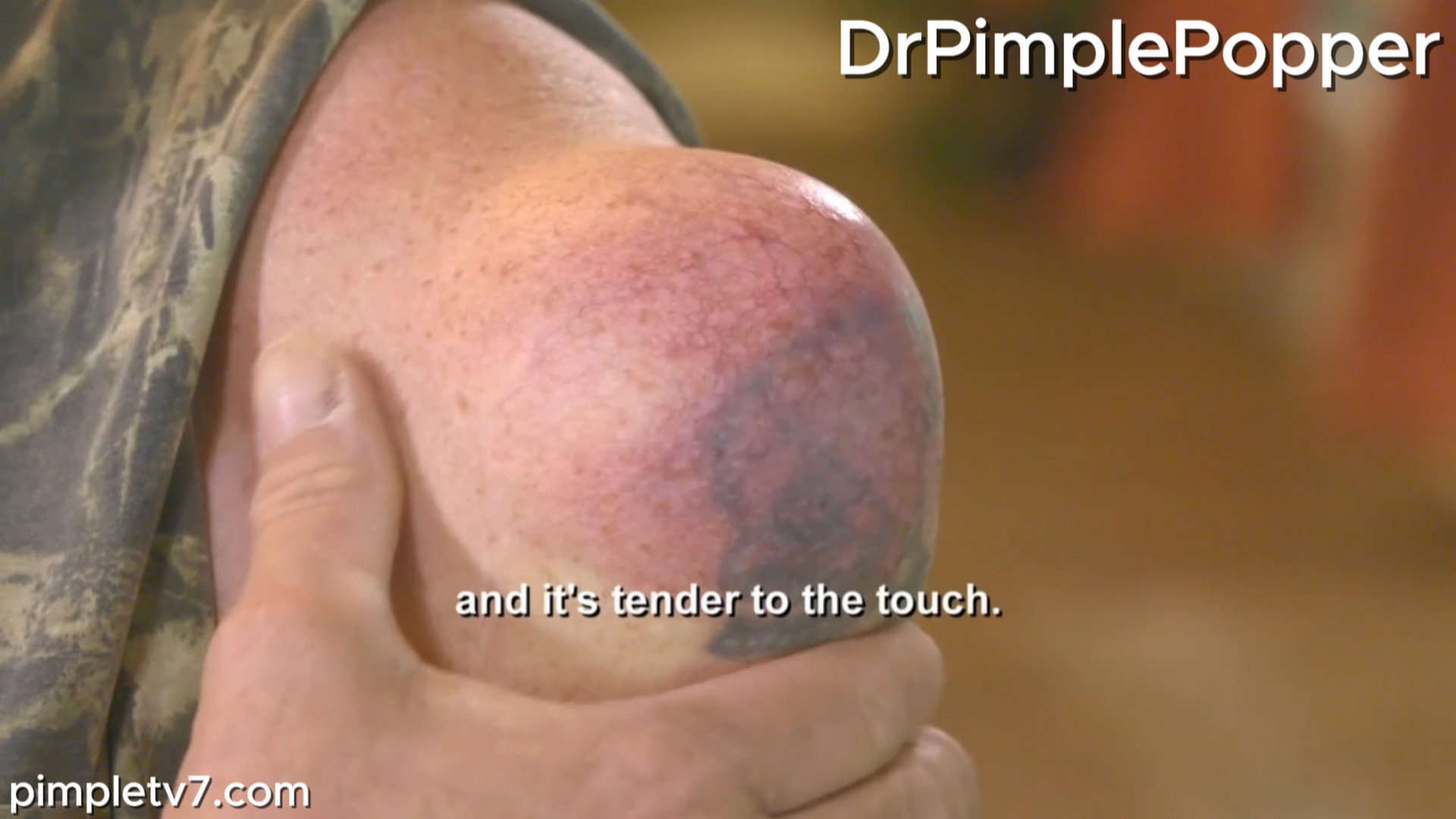 Marty has a large, 30-year-old growth on his shoulder that he is ready to remove himself from. Dr. Pimple Popper 040826