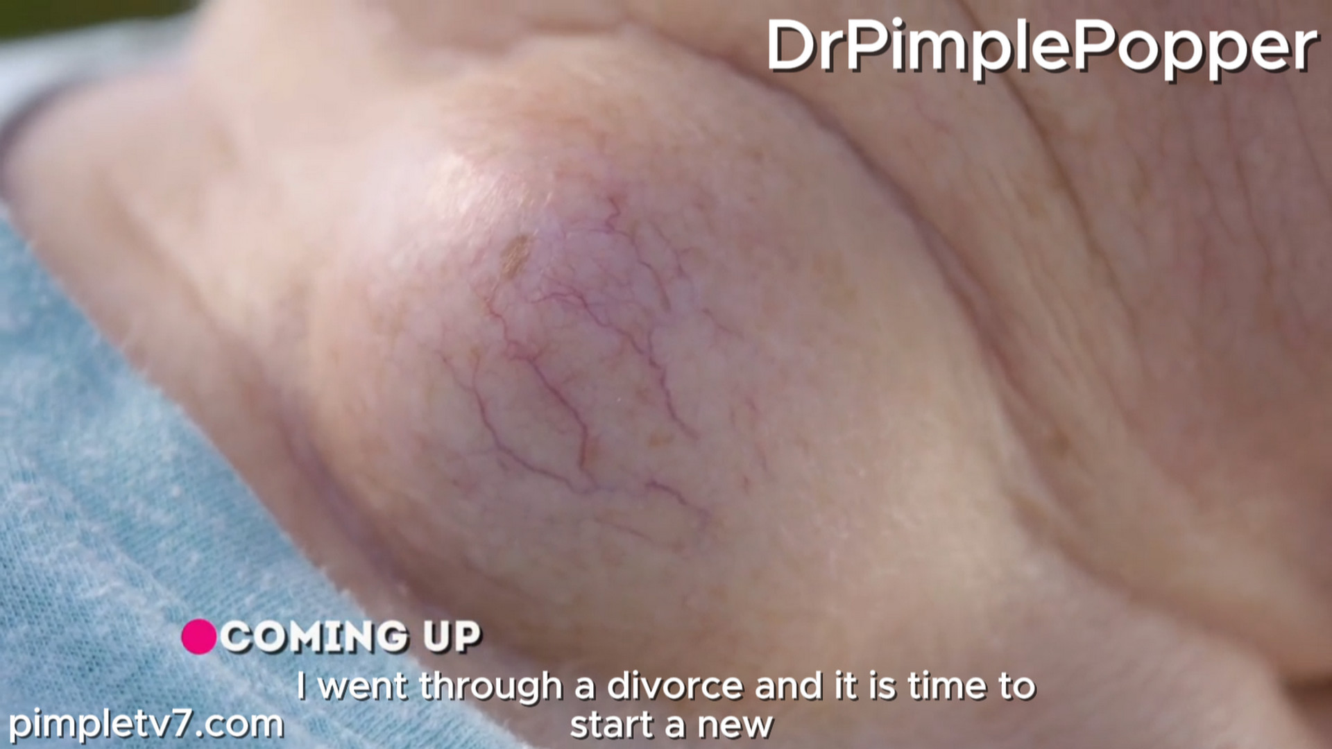 Mary Jo has a throbbing bump on her neck. Dr. Pimple Popper 260826