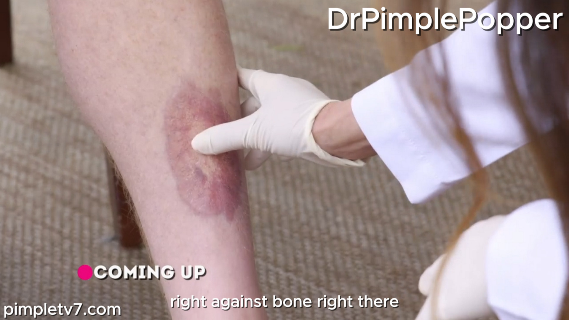 Matthew has a mysterious rash on his shin and worries it may be dangerous. Dr. Pimple Popper 130826