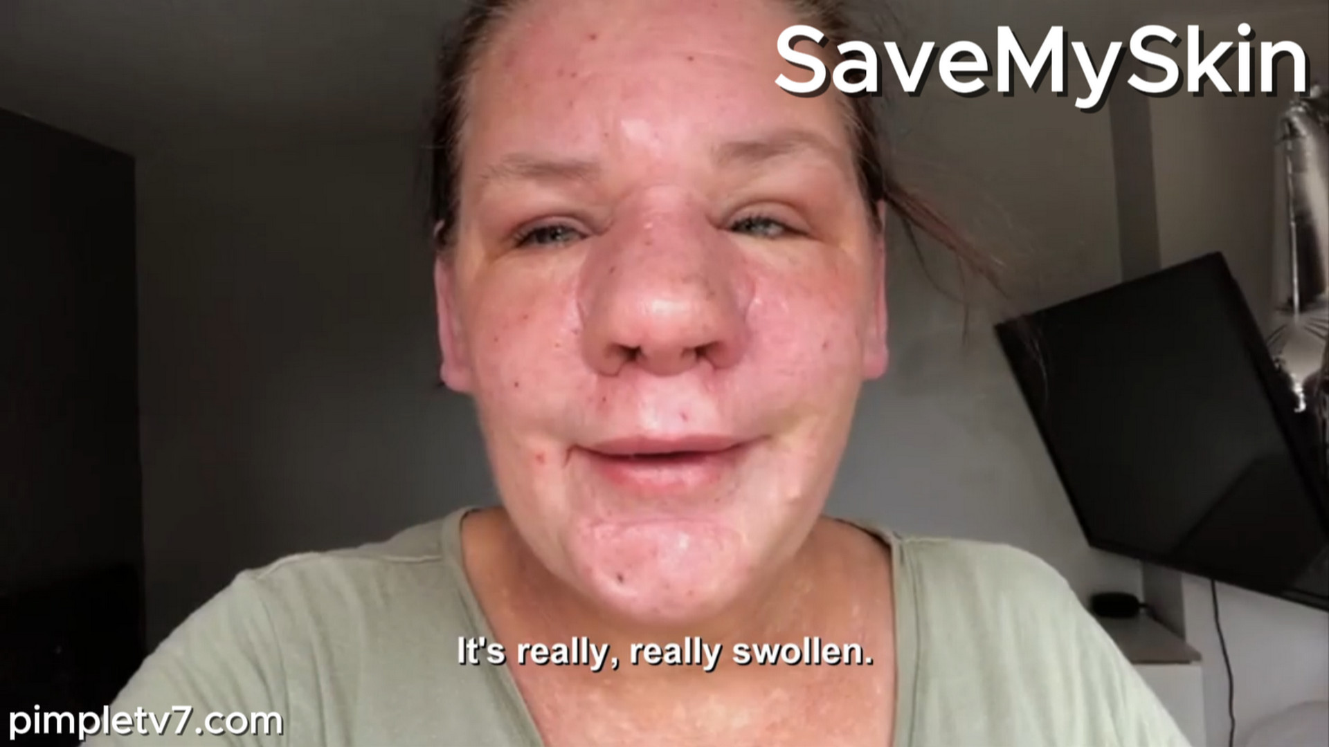 Michelle doesn’t recognize her own face. SaveMySkin 140826