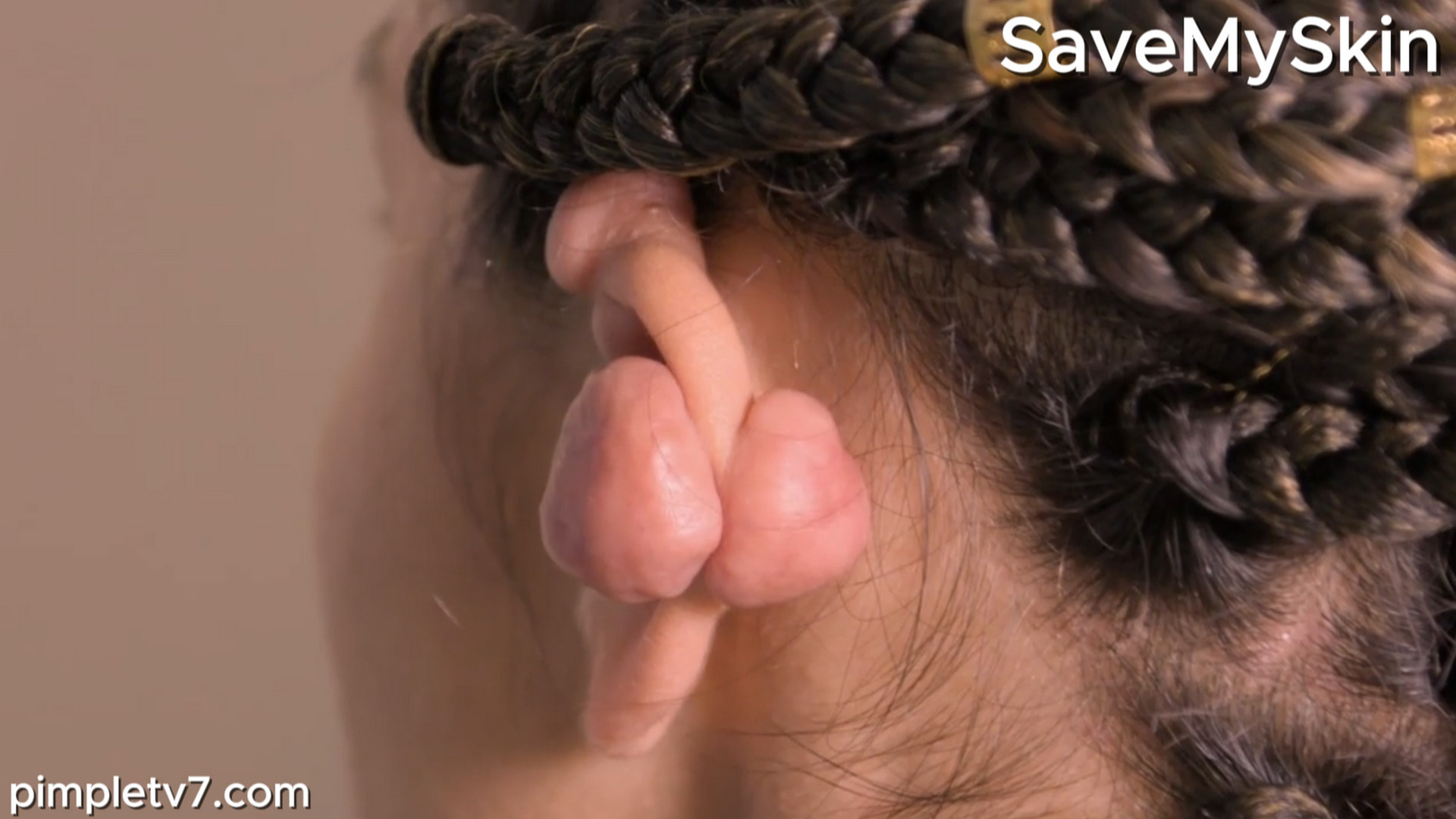 Miya has a cluster of keloids on her ear. SaveMySkin 020826