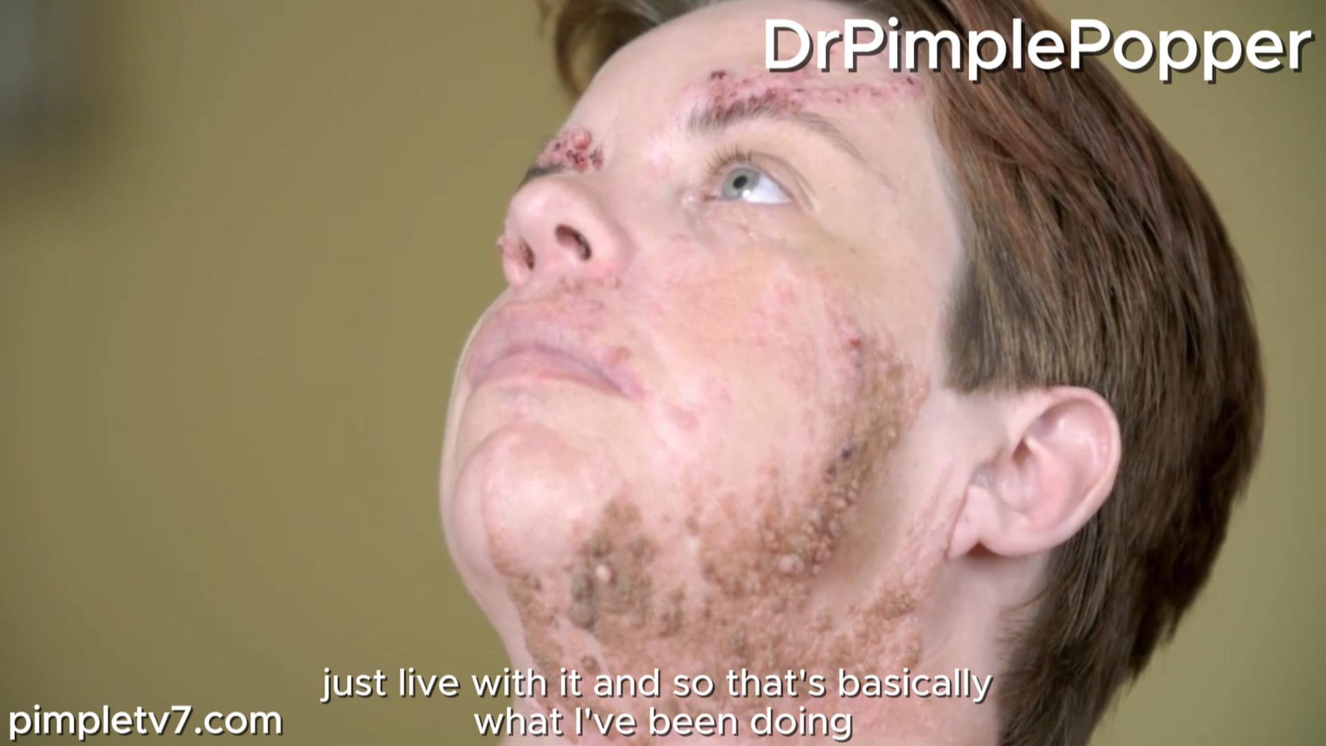 Monica returns for a second time in the hopes that Dr. Lee can remove some more of her face growths. Dr. Pimple Popper 090826