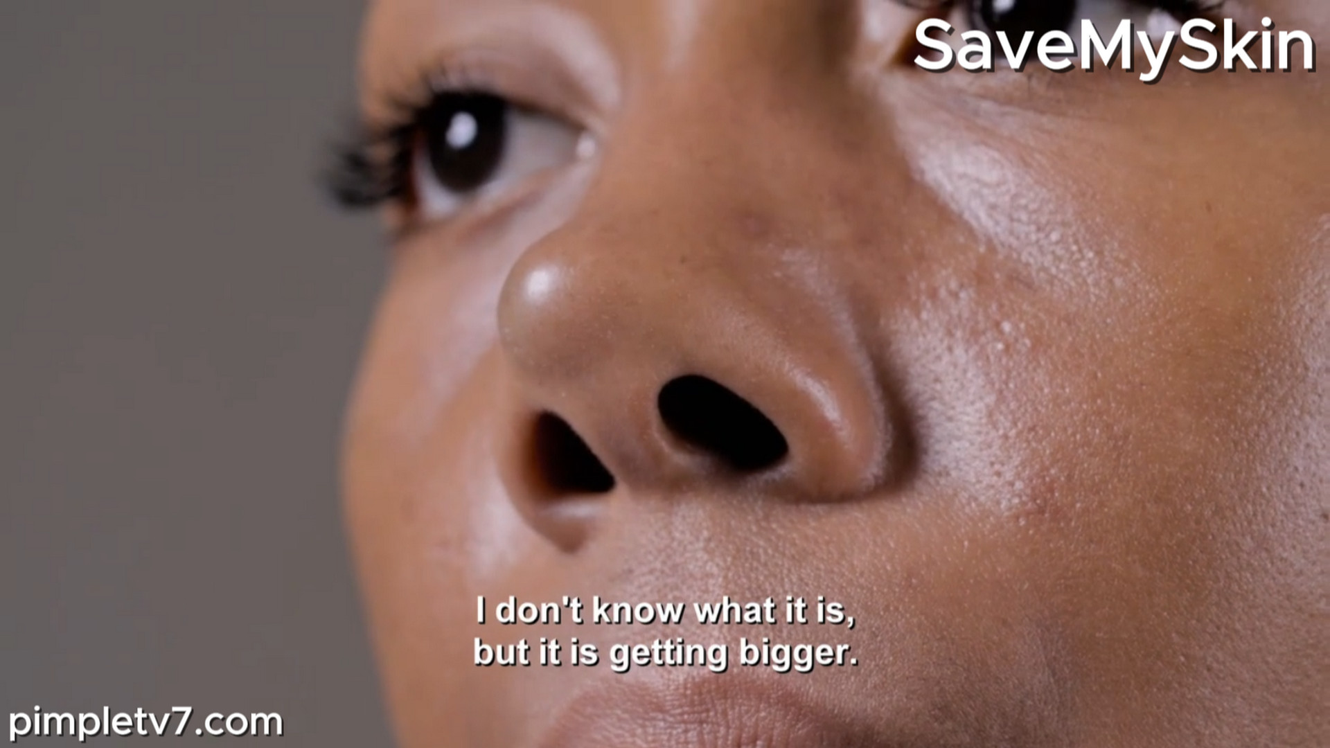 Monique has a cyst on her nose. SaveMySkin 050826