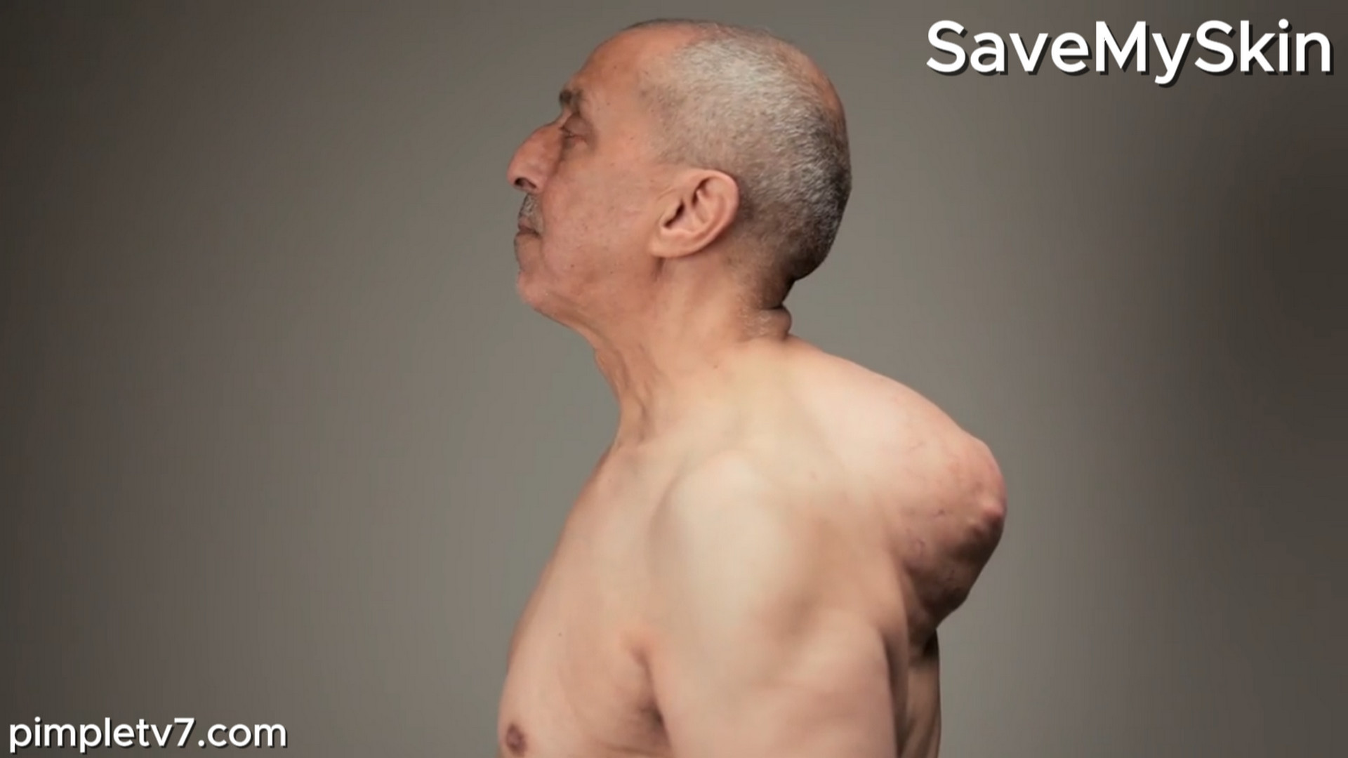 Najib has the biggest lipoma. Dr. Emma has ever seen. SaveMySkin 290826