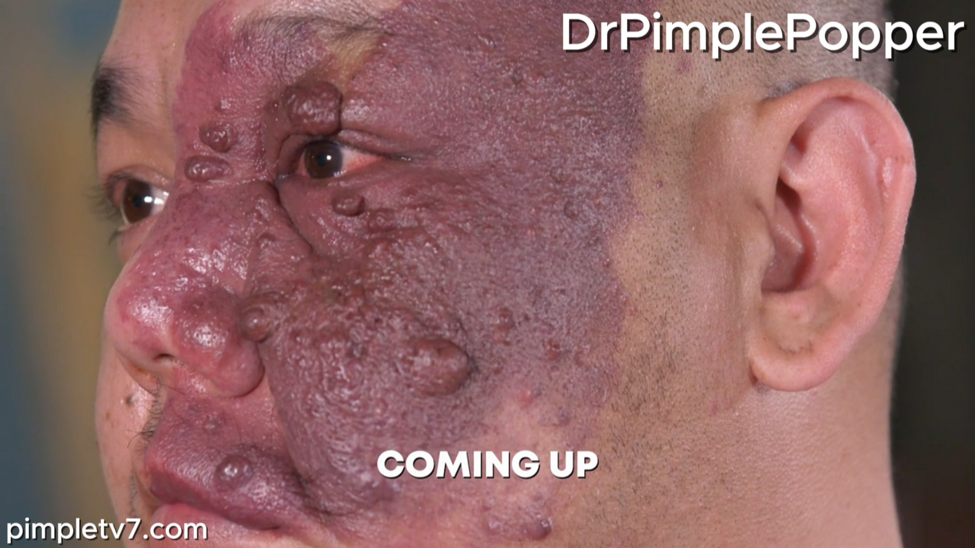 Nhan has an extreme, red birthmark that covers half his face. Dr. Pimple Popper 120826
