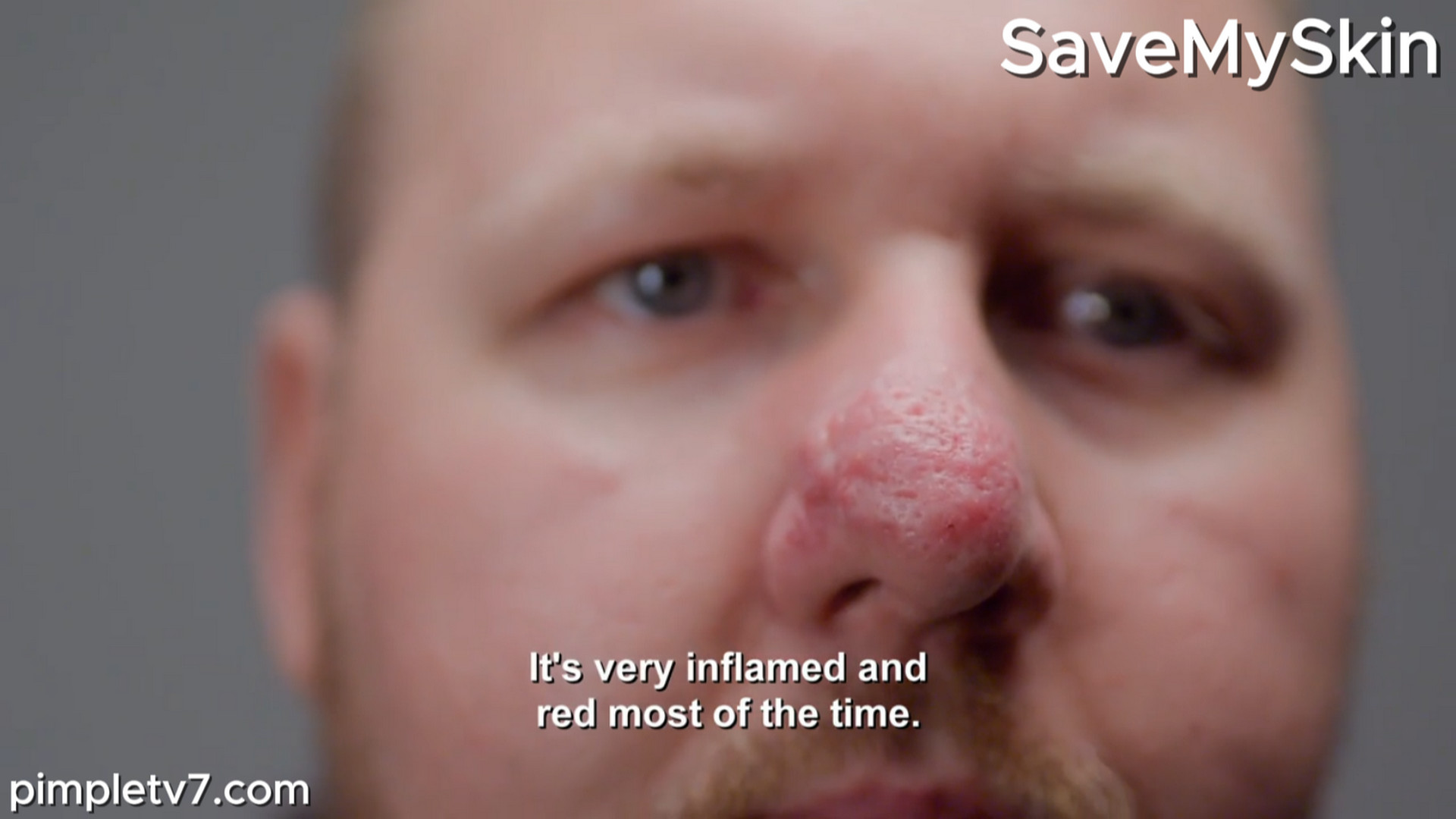 Nick suffers from a form of rosacea. SaveMySkin 060826