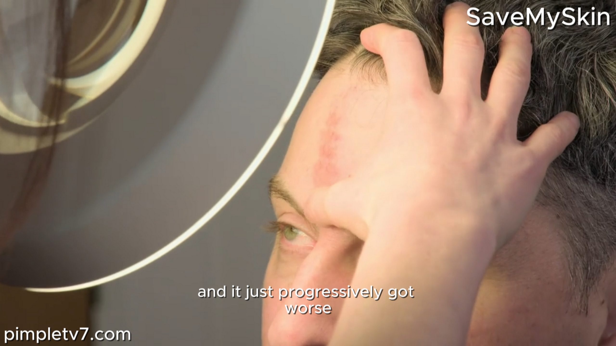 Rael hopes Dr. Emma can diagnose a skin condition on his forehead. SaveMySkin 130826