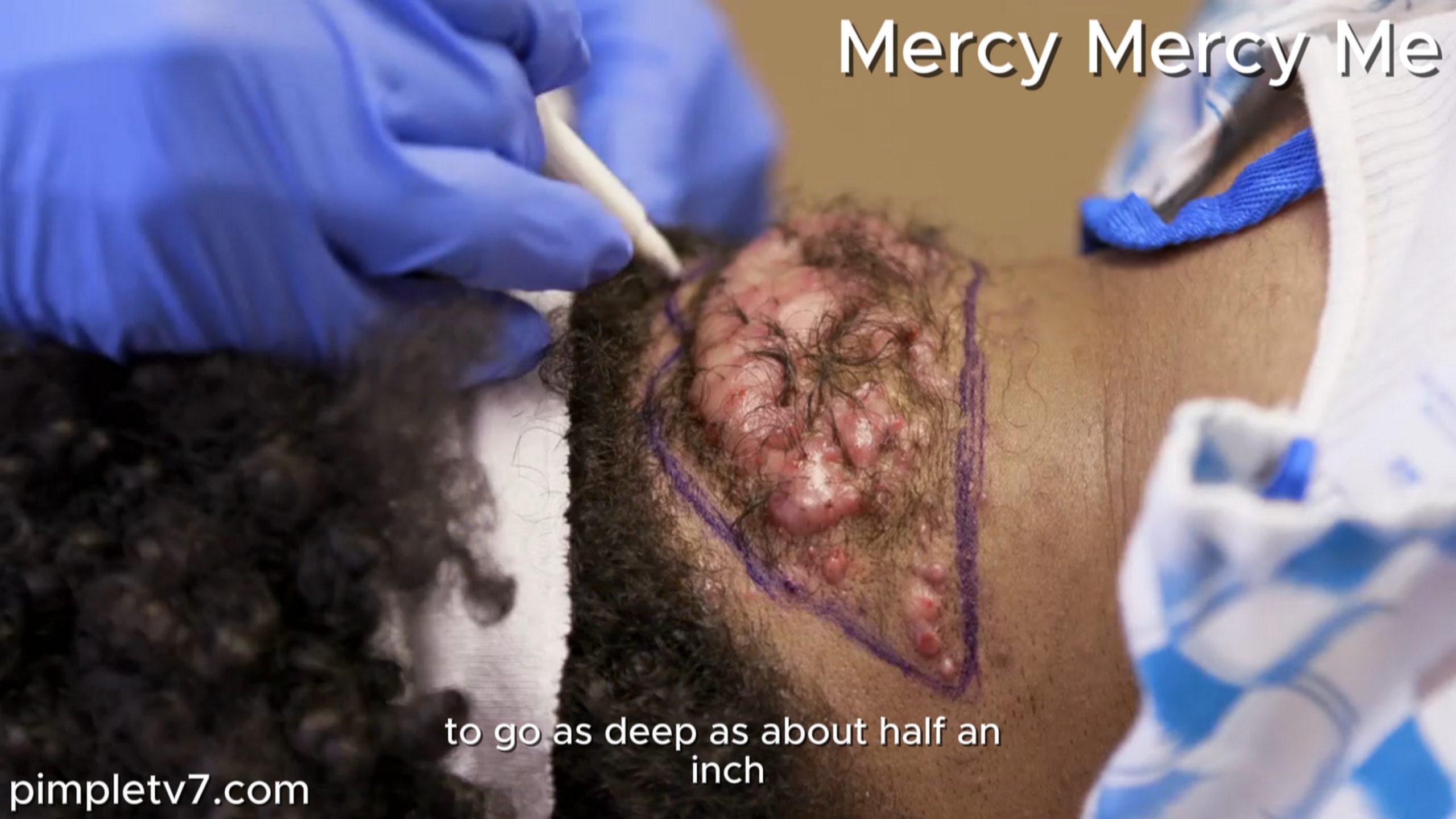 Ramon’s keloids on the back of his head are so large that he may require a skin graft if removed. MercyMercyMe 230826