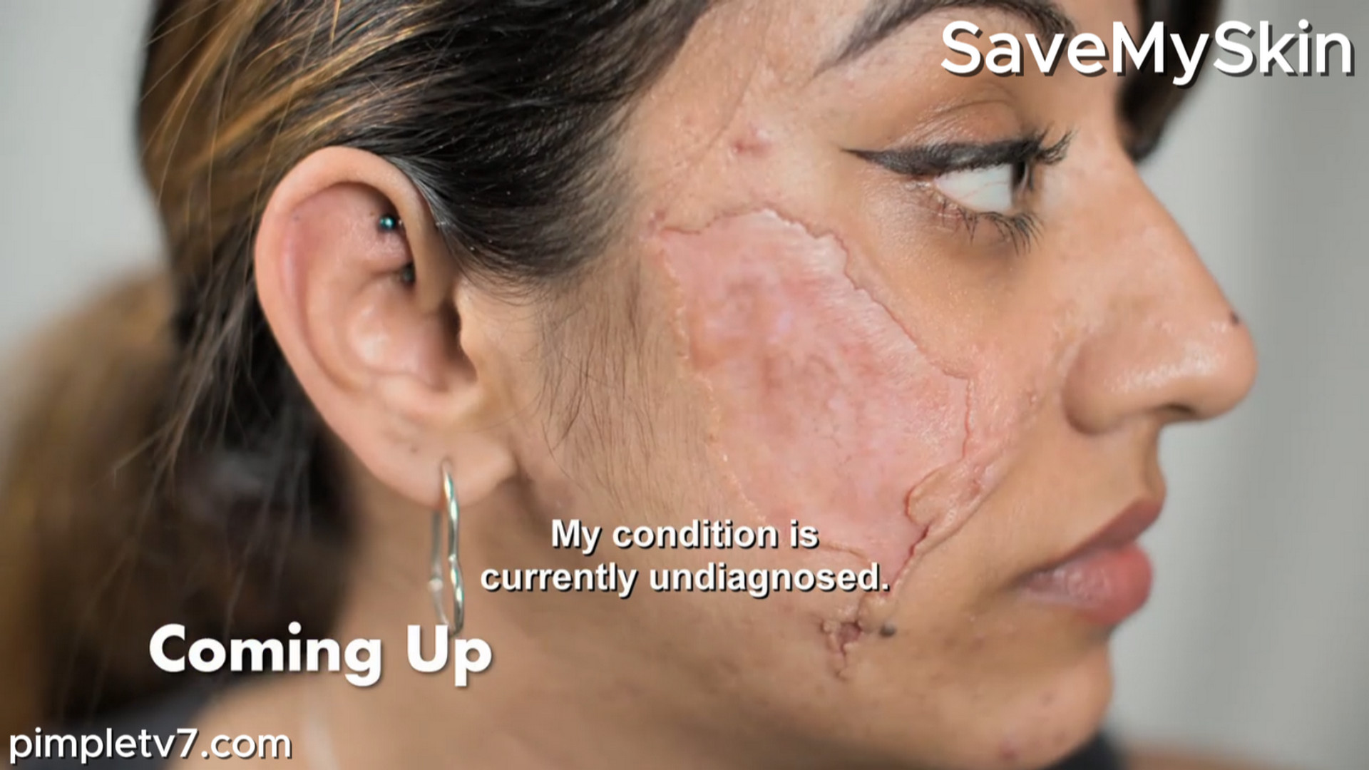 Rimi’s skin condition makes her feel like a zombie. SaveMySkin 150826