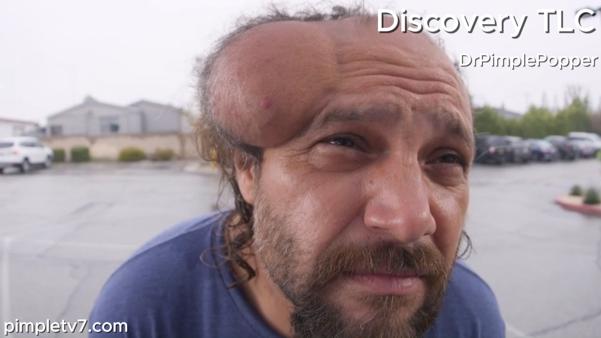 Robert carries the weight of providing for his family and the weight of the huge lump on his head. Dr. Pimple Popper 060826