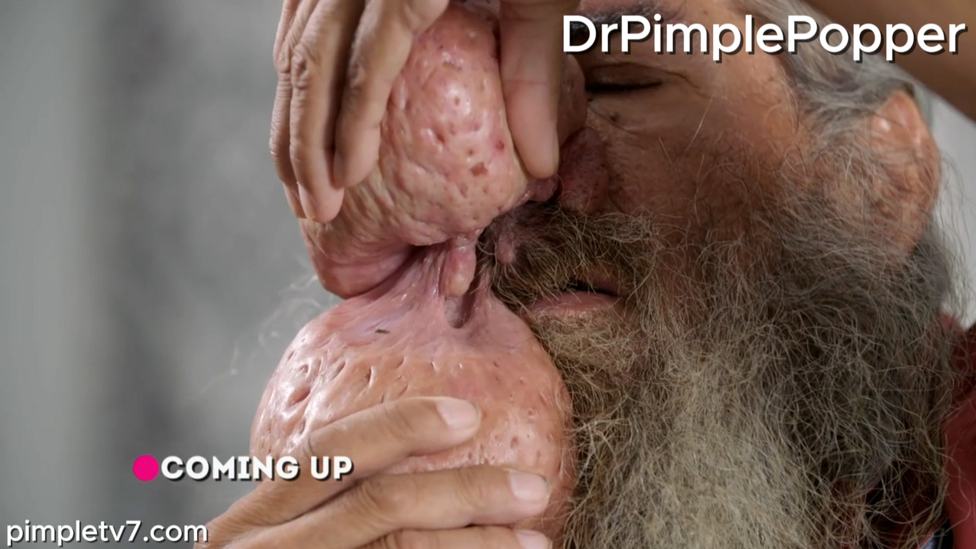 Roger has enormous growths on his nose that drip pus, attract flies, and are so large. Dr. Pimple Popper 050826