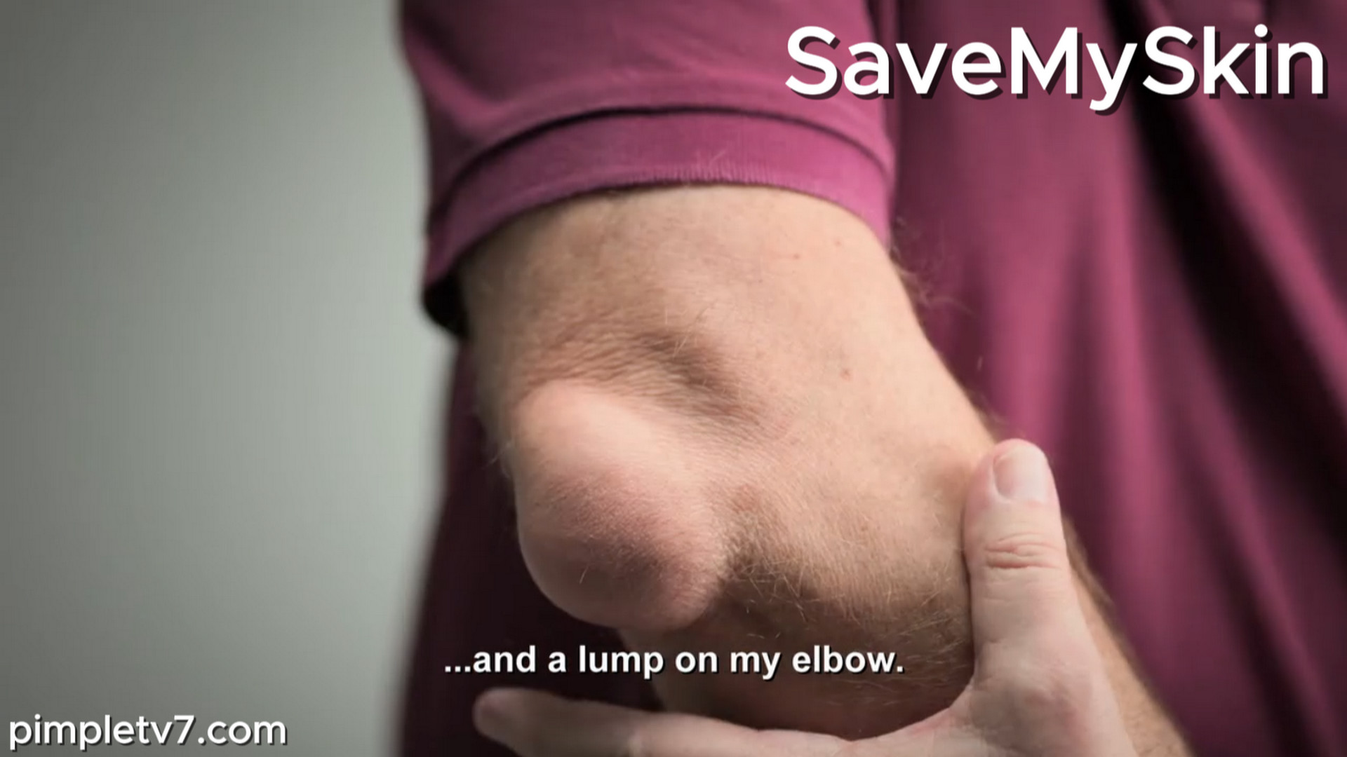 Roger’s gout jeopardizes his career. SaveMySkin 280826