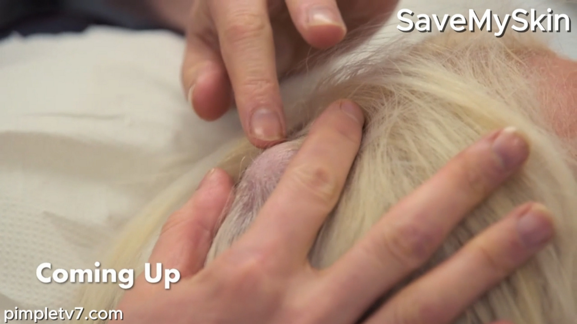 Samantha, a pilar cyst forms as a little outpouching from the outer part of a hair follicle. SaveMySkin 260826