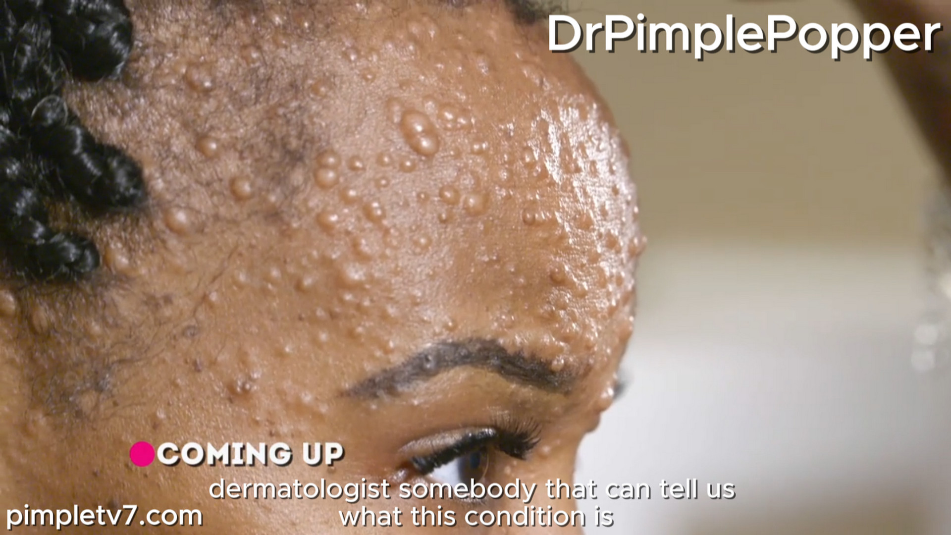 Sandra and Jessie are sisters who bonded over their many undiagnosed face bumps. Dr. Pimple Popper 050826