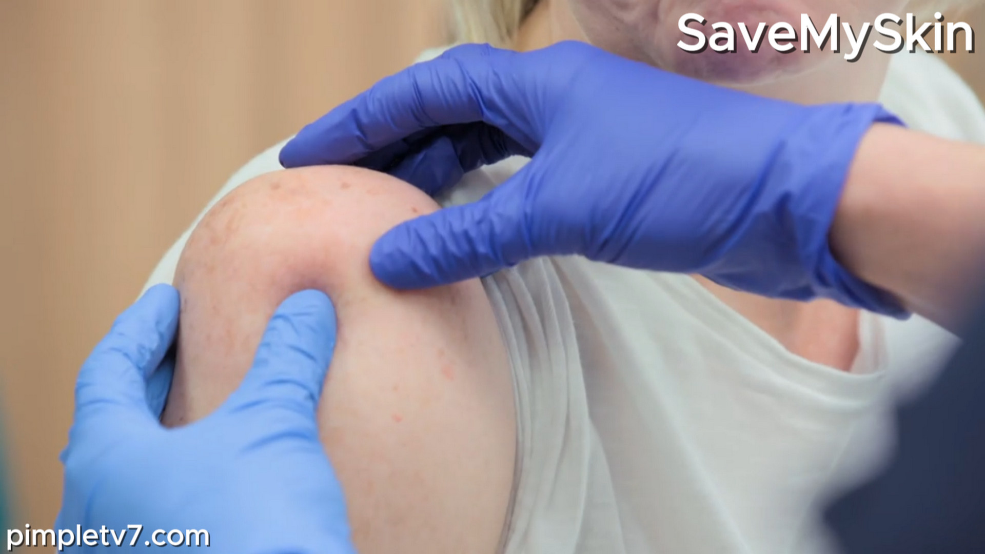 Sharon has a large lipoma on her shoulder. SaveMySkin 030826